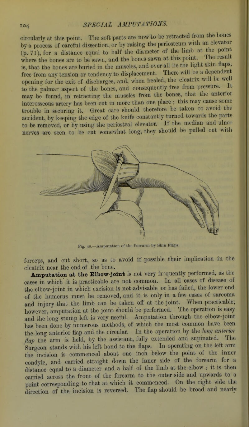 circularly at this point. The solt parts are now to be retracted from the bones by a process of careful dissection, or by raising the periosteum with an elevator (p. 71), for a distance equal to half the diameter of the limb at the point where the bones are to be sawn, and the bones sawn at this point. The result is, that the bones are buried in the muscles, and over all lie the light skm haps, free from any tension or tendency to displacement. There will be a dependent opening for the exit of discharges, and, when healed, the cicatrix will be wel to the palmar aspect of the bones, and consequently free from pressure, it may be found, in retracting the muscles from the bones, that the anterior interosseous artery has been cut in more than one place ; this may cause some trouble in securing it. Great care should therefore be taken to avoid the accident, by keeping the edge of the knife constantly turned towards the parts to be removed, or by usingl^he periosteal elevator. If the median and ulnar nerves are seen to be cut somewhat long, they should be pulled out with Fig. 40.—Amputation of the FoiTariu by Skin Flaps. forceps, and cut short, so as to avoid if possible their impUcation in the cicatrix near the end of the bone. Amputation at the Elbow-joiut is not very frequently performed, as the cases in which it is practicable are not common. In all cases of disease of the elbow-joint in which excision is not advisable or has failed, the lower end of the humerus must be removed, and it is only in a few cases of sarcoma and injury that the limb can be taken off at the joint. When practicable, however, amputation at the joint should be performed. The operation is easy and the long stump left is very useful. Amputation through the elbow-joint has been done by numerous methods, of which the most common have been the long anterior flap and the circular. In the operation by the Jong anterior Jiap the arm is held, by the assistant, fully extended and supinated. The Surgeon stands with his left hand to the flaps. In operating on the left arm the''incision is commenced about one inch below the point of the inner condyle, and carried straight down the inner side of the forearm for a distance equal to a diameter and a half of the limb at the elbow ; it is then carried across the front of the forearm to the outer side and upwards to a point corresponding to that at which it commenced. On the right side the direction of the incision is reversed. The flap should be broad and nearly
