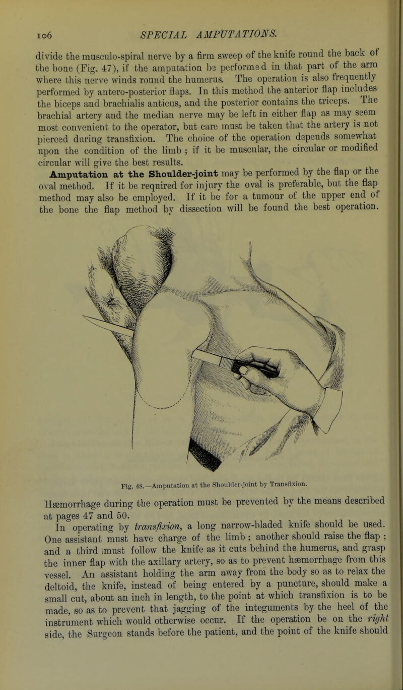 divide the musculo-spiral nerve by a firm sweep of the knife round the back of the bone (Fig. 47), if the amputation ba performed in that part of the arm where this nerve winds round the humerus. The operation is also frequently performed by antero-posterior flaps. In this method the anterior flap includes the biceps and brachialis anticus, and the posterior contains the triceps. The brachial artery and the median nerve may be left in either flap as may seem most convenient to the operator, but care must be taken that the artery is not pierced daring transfixion. The choice of the operation depends somewhat upon the condition of the limb ; if it be muscular, the circular or modified circular will give the best results. Amputation at the Shoulder-joint may be performed by the flap or the oval method. If it be required for injury the oval is preferable, but the flap method may also be employed. If it be for a tumour of the upper end of the bone the flap method by dissection will be found the best operation. Fig. 4S.—Amputation at the Shoulder-joint by Transfixion. Haemorrhage during the operation must be prevented by the means described at pages 47 and 50. In operating by transfixion, a long narrow-bladed knife should be used. One assistant must have charge of the limb ; another should raise the flap ; and a third must follow the knife as it cuts behind the humerus, and grasp the inner flap with the axillary artery, so as to prevent haemorrhage from this vessel. An assistant holding the arm away from the body so as to relax the deltoid, the knife, instead of being entered by a puncture, should make a small cut, about an inch in length, to the point at which transfixion is to be made, so as to prevent that jagging of the integuments by the heel of the instrument which would otherwise occur. If the operation be on the right side, the Surgeon stands before the patient, and the point of the knife should