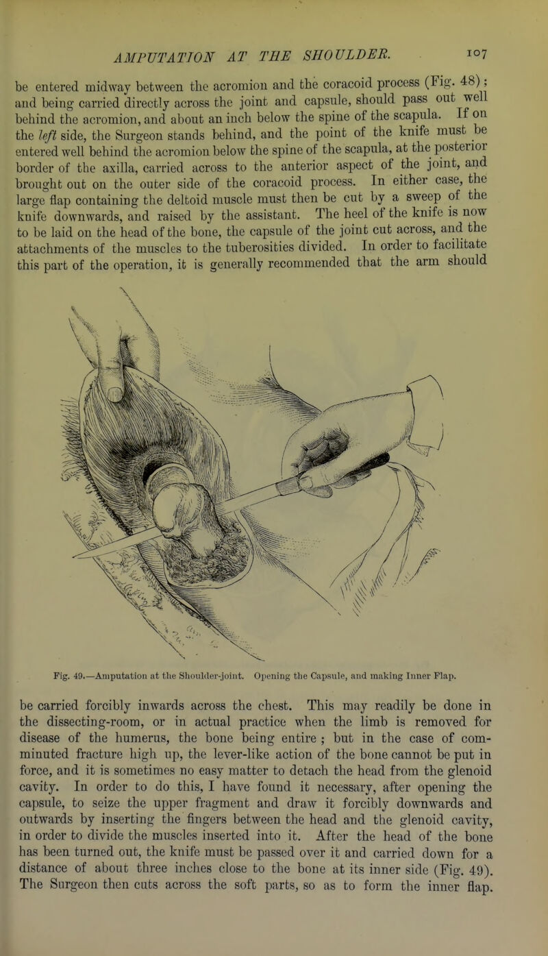 be entered midway between the acromion and the coracoid process (Fig. 48); and being carried directly across the joint and capsnle, should pass out well behind the acromion, and about an inch below the spine of the scapula. If on the Uft side, the Surgeon stands behind, and the point of the knife must be entered weU behind the acromion below the spine of the scapula, at the posterior border of the axilla, carried across to the anterior aspect of the joint, and brought out on the outer side of the coracoid process. In either case, the large flap containing the deltoid muscle must then be cut by a sweep of the knife downwards, and raised by the assistant. The heel of the knife is now to be laid on the head of the bone, the capsule of the joint cut across, and the attachments of the muscles to the tuberosities divided. In order to facihtate this part of the operation, it is generally recommended that the arm should Fig. 49.—Amputation at the Shoulder-joint. Opening the Capsule, and making Inner Flap. be carried forcibly inwards across the chest. This may readily be done in the dissecting-room, or in actual practice when the limb is removed for disease of the humerus, the bone being entire ; but in the case of com- minuted fracture high up, the lever-like action of the bone cannot be put in force, and it is sometimes no easy matter to detach the head from the glenoid cavity. In order to do this, I have found it necessary, after opening the capsule, to seize the upper fragment and draw it forcibly downwards and outwards by inserting the fingers between the head and the glenoid cavity, in order to divide the muscles inserted into it. After the head of the bone has been turned out, the knife must be passed over it and carried down for a distance of about three inches close to the bone at its inner side (Fig. 49). The Surgeon then cuts across the soft parts, so as to form the inner flap.