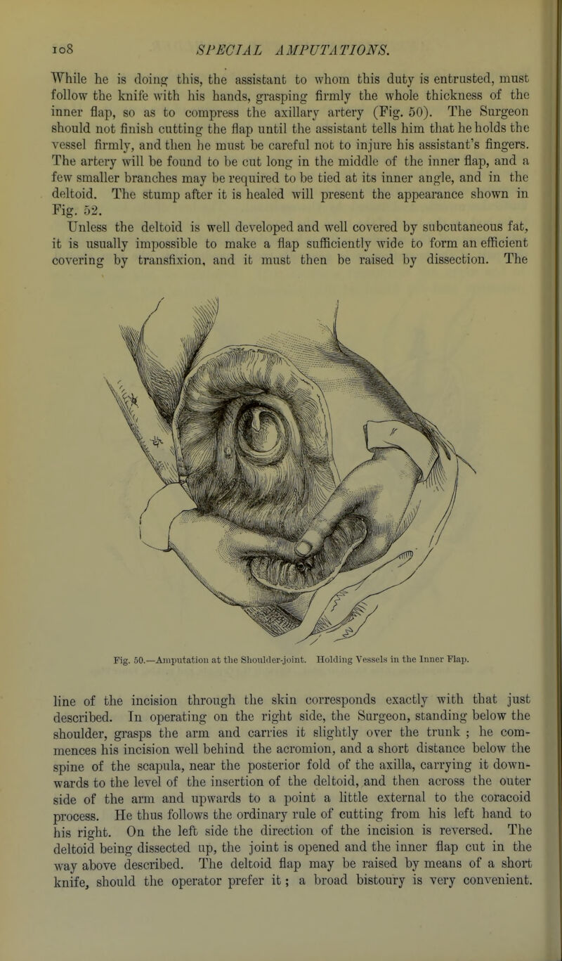 While he is doiiijs; this, the assistant to whom this duty is entrusted, must follow the knife with his hands, grasping firmly the whole thickness of the inner flap, so as to compress the axillary artery (Fig. 50). The Surgeon should not finish cutting the flap until the assistant tells him that he holds the vessel firmly, and then he must be careful not to injure his assistant's fingers. The artery will be found to be cut long in the middle of the inner flap, and a few smaller branches may be required to be tied at its inner angle, and in the deltoid. The stump after it is healed will present the appearance shown in Fig, 52. Unless the deltoid is well developed and well covered by subcutaneous fat, it is usually impossible to make a flap sufficiently wide to form an efficient covering by transfixion, and it must then be raised by dissection. The Fig. 50.—Amputation at tlie Shouliler-joint. HoUling Vessels in the Inner Flap. line of the incision through the skin corresponds exactly with that just described. In operating on the right side, the Surgeon, standing below the shoulder, grasps the arm and carries it slightly over the trunk ; he com- mences his incision well behind the acromion, and a short distance below the spine of the scapula, near the posterior fold of the axilla, carrying it down- wards to the level of the insertion of the deltoid, and then across the outer side of the arm and upwards to a point a little external to the coracoid process. He thus follows the ordinary rule of cutting from his left hand to his right. On the left side the direction of the incision is reversed. The deltoid being dissected up, the joint is opened and the inner flap cut in the way above described. The deltoid flap may be raised by means of a short knife, should the operator prefer it; a broad bistoury is very convenient.