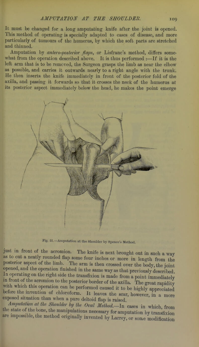 It must be changed for a long amputating knife after the joint is opened. This method of operating is specially adapted to cases of disease, and more particularly of tumours of the humerus, by which the soft parts are stretched and thinned. Amputation by antero-posterior flaps, or Lisfranc's method, differs some- what from the operation described above. It is thus performed :—If it is the left arm that is to be removed, the Surgeon grasps the limb as near the elbow as possible, and carries it outwards nearly to a right angle with the trunk. He then inserts the knife immediately in front of the posterior fold of the axilla, and passing it forwards so that it crosses the neck of the humerus at its posterior aspect immediately below the head, he makes the point emerge Fig. 01.—Amputation at tlie Slioulder by Spence'.s Method. just in front of the acromion. The knife is next brought out in such a way as to cut a neatly rounded flap some four inches or more in length from the posterior aspect of the limb. The arm is then crossed over the body, the joint opened, and the operation linisliod in the same way as that previously described In operating on the right side the transfixion is made from a point immediately in front ot the acromion to the posterior border of the axilla. The great rapidity with which this operation can be performed caused it to be highly appreciated before he invention of chloroform. It leaves the scar, however, in a more exposed situation than when a pure deltoid flap is raised Amputation at the Shoulder ly the Oval Method.-lr, cases in which, from the state of the bone, the manipulations necessary for amputation by transfixion are impossible, the method originally invented by Larrey, or some modification