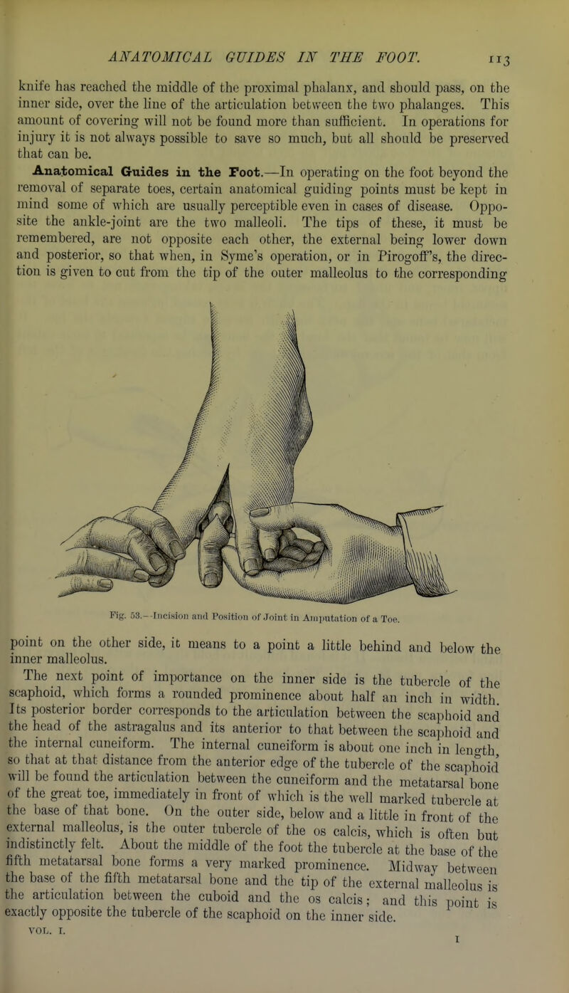 knife has reached the middle of the proximal phalanx, and should pass, on the inner side, over the line of the articulation between the two phalanges. This amount of covering will not be found more than sufficient. In operations for injury it is not always possible to save so much, but all should be preserved that can be. Anatomical Guides in the Foot.—In operating on the foot beyond the removal of separate toes, certain anatomical guiding points must be kept in mind some of which are usually perceptible even in cases of disease. Oppo- site the ankle-joint are the two malleoli. The tips of these, it must be remembered, are not opposite each other, the external being lower down and posterior, so that when, in Syme's operation, or in Pirogoff's, the direc- tion is given to cut from the tip of the outer malleolus to the corresponding Fig. o3.--Iiicision and Position of Joint in Amputation of a Toe. point on the other side, it means to a point a little behind and below the inner malleolus. The next point of importance on the inner side is the tubercle of the scaphoid, which forms a rounded prominence about half an inch in width Its posterior border corresponds to the articulation between the scaphoid and the head of the astragalus and its anterior to that between the sca]ilioid and the internal cuneiform. The internal cuneiform is about one inch in length so that at that distance from the anterior edge of the tubercle of the scaphoid will be found the articulation between the cuneiform and the metatarsal bone of the great toe, immediately in front of which is the well marked tubercle at the base of that bone. On the outer side, below and a little in front of the external malleolus, is the outer tubercle of the os calcis, which is often but indistinctly felt. About the middle of the foot the tubercle at the base of the fifth metatarsal bone forms a very marked prominence. Midway between the base of the fifth metatarsal bone and the tip of the external malleolus is the articulation between the cuboid and the os calcis; and this point is exactly opposite the tubercle of the scaphoid on the inner side. VOL. I. I