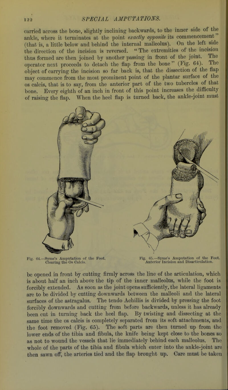 carried across the bone, slightly inclining backwards, to the inner side of the ankle, where it terminates at the point exactly opposite its commencement (that is, a little below and behind the internal malleolus). On the left side the direction of the incision is reversed.  The extremities of the incision thus formed are then joined by another passing in front of the joint. The operator next proceeds to detach the flap from the bone  (Fig. 64). The object of carrying the incision so far back is, that the dissection of the flap may commence fi'om the most prominent point of the plantar surface of the OS calcis, that is to say, from the anterior part of the two tubercles of that bone. Every eighth of an inch in front of this point increases the difficulty of raising the flap. When the heel flap is turned back, the ankle-joint must 1 Fig. 64.—Syme's Amputation of the Foot. Fig. 65.—Syiue's Ampiitation of the Foot. Clearing the Os Calci.s. Anterior Incision and Disarticulation. be opened in front by cutting firmly across the line of the articulation, which is about half an inch above the tip of the inner malleolus, while the foot is forcibly extended. As soon as the joint opens sufficiently, the lateral ligaments are to be divided by cutting downwards between the malleoli and the lateral surfaces of the astragalus. The tendo Achillis is divided by pressing the foot forcibly downwards and cutting from before backwards, unless it has already been cut in turning back the heel flap. By twisting and dissecting at the same time the os calcis is completely separated from its soft attachments, and the foot removed (Fig. 65). The soft parts are then turned up from the lower ends of the tibia and fibula, the knife being kept close to the bones so as not to wound the vessels that lie immediately behind eacb malleolus. The whole of the parts of the tibia and fibula which enter into the ankle-joint are then sawn ofiT, the arteries tied and the flap brought up. Care must be taken
