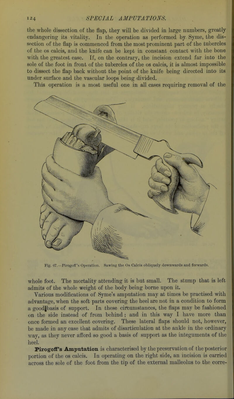 the whole dissection of the flap, they will be divided in large numbers, greatly endangering its vitality. In the operation as performed by. Syme, the dis- section of the flap is commenced from the most prominent part of the tubercles of the OS calcis, and the knife can be kept in constant contact with the bone with the greatest ease. If, on the contrary, the incision extend far into the sole of the foot in front of the tubercles of the os calcis, it is almost impossible to dissect the flap back without the point of the knife being directed into its under surface and the vascular loops being divided. This operation is a most useful one in all cases requiring removal of the Fig. (57.—PirogofT's Operation. Sawing the Os Calcis obliquely downwards and forwards. whole foot. The mortality attending it is but small. The stump that is left admits of the whole weight of the body being borne upon it. Various modifications of Syme's amputation may at times be practised Avith advantage, when the soft parts covering the heel are not in a condition to form a good|basis of support. In these circumstances, the flaps may be fashioned on the side instead of from behind ; and in this way I have more than once formed an excellent covering. These lateral flaps should not, however, be made in any case that admits of disarticulation at the ankle in the ordinary way, as they never afford so good a basis of support as the integuments of the heel. Pirogoff's Amputation is characterised by the preservation of the posterior portion of the os calcis. In operating on the right side, an incision is carried across the sole of the foot fi-om the tip of the external malleolus to the corre-