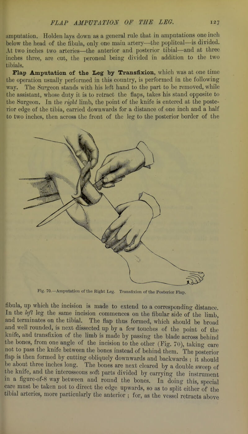 amputation. Holden lays down as a general rule that in amputations one inch below the head of the fibula, only one main artery—the popliteal—is divided. At two inches two arteries—the anterior and posterior tibial—and at three inches three, are cut, the peroneal being divided in addition to the two tibials. Flap Amputation of the Leg by Transfixion, which was at one time the operation usually performed in this country, is performed in the following way. The Surgeon stands with his left hand to the part to be removed, while the assistant, whose duty it is to retract the flaps, takes his stand opposite to the Surgeon. In the right limb, the point of the knife is entered at the poste- rior edge of the tibia, carried downwards for a distance of one inch and a half to two inches, then across the front of the leg to the posterior border of the Fig. 70.—Ainiiutatiou of tlie Right Leg. Transfixion of the Posterior Flap. fibula, up which the incision is made to extend to a corresponding distance. In the left leg the same incision commences on the fibular side of the limb, and terminates on the tibial. The flap thus formed, which should be broad and well rounded, is next dissected up by a few touches of the point of the knife, and transfixion of the limb is made by passing the blade across behind the bones, from one angle of the incision to the other (Fig. 70), taking care not to pass the knife between the bones instead of behind them. The posterior flap is then formed by cutting obliquely downwards and backwards ; it should be about three inches long. The bones are next cleared by a double sweep of the knife, and the interosseous soft parts divided by carrying the instrument in a figure-of-8 way between and round the bones. In doino- this, special care must be taken not to direct the edge upwards, so as to split either of the tibial arteries, more particularly the anterior ; for, as the vessel retracts above