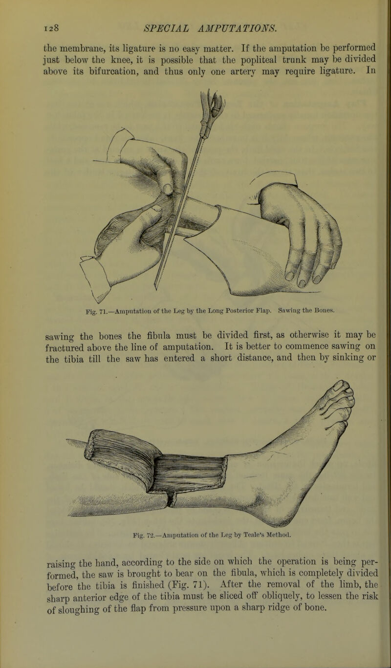 the membrane, its ligature is no easy matter. If the amputation be performed just below the knee, it is possible that the popliteal trunk may be divided above its bifurcation, and thus only one artery may require ligature. In Pig. 71.—Amputation of the Leg bj- the Long Posterior Flap. Sawing the Bones. sawing the bones the fibula must be divided first, as otherwise it may be | fractured above the line of amputation. It is better to commence sawing on I the tibia till the saw has entered a short distance, and then by sinking or Fig. 7'2.—Anipntiition of the Leg by Teale's Method. raising the hand, according to the side on which the operation is being per- formed, the saw is brought to bear on the fibula, which is completely divided before the tibia is finished (Fig. 71). After the removal of the limb, the sharp anterior edge of the tibia must be sliced off obhquely, to lessen the risk of sloughing of the flap from pressure upon a sharp ridge of bone.