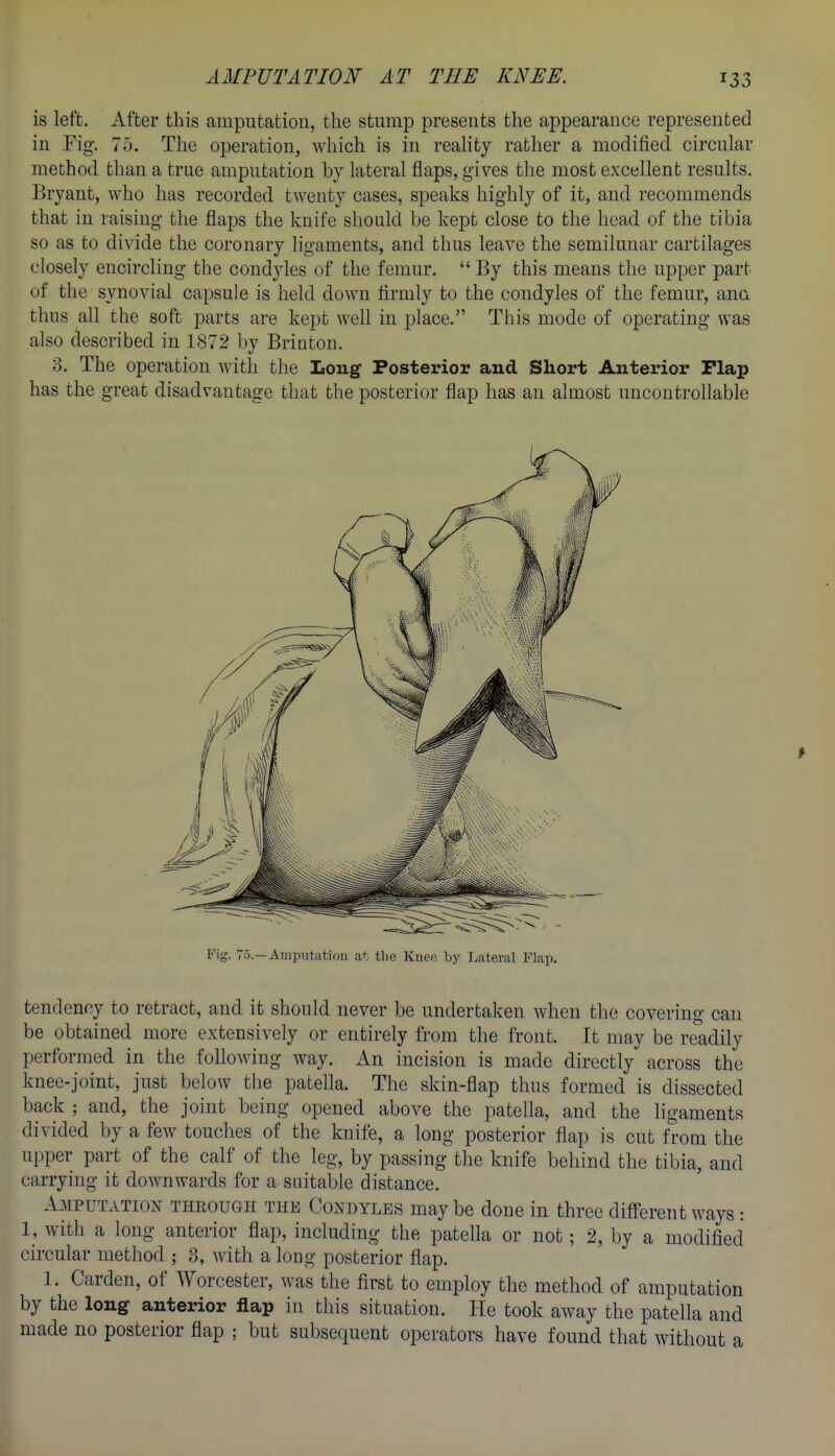 is left. After this amputation, the stiirap presents the appearance represented in Fig. 75. The operation, which is in reahty rather a modified circular method than a true amputation by lateral flaps, gives the most excellent results. Bryant, who has recorded twenty cases, speaks highly of it, and recommends that in raising the flaps the knife should be kept close to the head of the tibia so as to divide the coronary ligaments, and thus leave the semilunar cartilages closely encircling the condyles of the femur.  By this means the upper part of the synovial capsule is held down firmly to the condyles of the femur, ana thus all the soft parts are kept well in place. This mode of operating was also described in 1872 by Brinton. 3. The operation with the Long Posterior and Short Anterior Flap has the great disadvantage that the posterior flap has an almost uncontrollable tendency to retract, and it should never be undertaken Avhen the covering can be obtained more extensively or entirely from the front. It may be readily performed in the following way. An incision is made directly across the knee-joint, just below the patella. The skin-flap thus formed is dissected back ; and, the joint being opened above the patella, and the ligaments divided by a few touches of the knife, a long posterior flap is cut from the upper part of the calf of the leg, by passing the knife behind the tibia, and carrying it downwards for a suitable distance. Amputation through the Condyles maybe done in three different ways : 1, with a long anterior flap, including the patella or not; 2, by a modified circular method ; 3, with a long posterior flap. 1. Garden, of Worcester, was the first to employ the method of amputation by the long anterior flap in this situation. He took away the patella and made no posterior flap ; but subsequent operators have found that without a