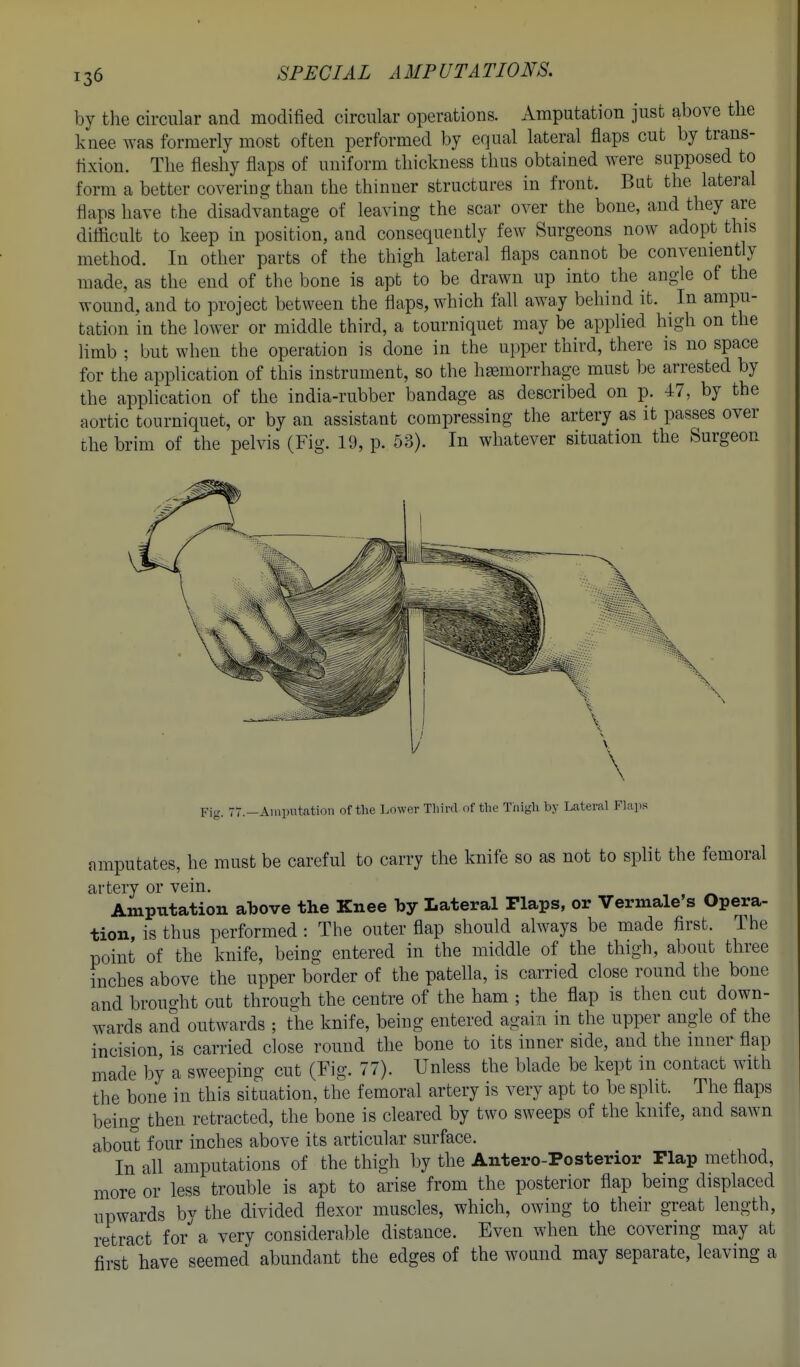 by the drcular and modified circular operations. Amputation just above the knee was formerly most often performed by equal lateral flaps cut by trans- fixion. The fleshy flaps of uniform thickness thus obtained were supposed to form a better covering than the thinner structures in front. But the lateral flaps have the disadvantage of leaving the scar over the bone, and they are ditticult to keep in position, and consequently few Surgeons now adopt this method. In other parts of the thigh lateral flaps cannot be conveniently made, as the end of the bone is apt to be drawn up into the angle of the wound, and to project between the flaps, which fall away behind it. _ In ampu- tation in the lower or middle third, a tourniquet may be applied high on the limb ; but when the operation is done in the upper third, there is no space for the application of this instrument, so the haemorrhage must be arrested by the application of the india-rubber bandage as described on p. 47, by the aortic tourniquet, or by an assistant compressing the artery as it passes over the brim of the pelvis (Fig. 19, p. 53). In whatever situation the Surgeon Fig. 77.—Amputation of the Lower Third of the Thigh by Lateral Flap,'! amputates, he must be careful to carry the knife so as not to split the femoral artery or vein. Amputation above the Knee by Lateral Flaps, or Vermale's Opera- tion, is thus performed : The outer flap should always be made first. The point of the knife, being entered in the middle of the thigh, about three inches above the upper border of the patella, is carried close round the bone and brought out through the centre of the ham ; the flap is then cut down- wards and outwards ; the knife, being entered again in the upper angle of the incision is carried close round the bone to its inner side, and the inner flap made by a sweeping cut (Fig. 77). Unless the blade be kept in contact with the bone in this situation, the femoral artery is very apt to be split. The flaps being then retracted, the bone is cleared by two sweeps of the kmfe, and sawn about four inches above its articular surface. In all amputations of the thigh by the Antero-Posterior Flap method, more or less trouble is apt to arise from the posterior flap being displaced upwards by the divided flexor muscles, which, owing to their great length, retract ior a very considerable distance. Even when the covering may at first have seemed abundant the edges of the wound may separate, leaving a