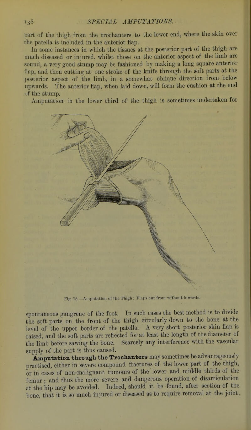 part of the thigh from the trochanters to the lower end, where the skin over the patella is included in the anterior flap. In some instances in which the tissues at the posterior part of the thigh are much diseased or injured, whilst those on the anterior aspect of the limb are sound, a very good stump may be fashioned by making a long square anterior flap, and then cutting at one stroke of the knife through the soft parts at the ])osterior aspect of the hmb, in a somewhat oblique direction from below upwards. The anterior flap, when laid down, will form the cushion at the end of the stump. Amputation in the lower 'third of the thigh is sometimes undertaken for Fig. VS.—Amputation of tlio Thigli: Fbips cut from without inwards. spontaneous gangrene of the foot. In such cases the best method is to divide the soft parts on the front of the thigh circularly down to the bone at the level of the upper border of the patella. A very short posterior skin flap is raised, and the soft parts are reflected for at least the length of the diameter of the limb before sawing the bone. Scarcely any interference with the vascular supply of the part is thus caused. Amputation through the Trochanters may sometimes be advantageously practised, either in severe compound fractures of the lower part of the thigh, or in cases of non-malignant tumours of the lower and middle thirds of the femur ; and thus the more severe and dangerous operation of disarticulation at the hip may be avoided. Indeed, should it be found, after section of the bone, that it is so much injured or diseased as to require removal at the joint,
