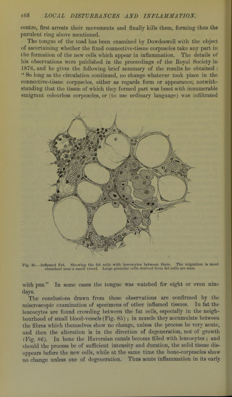 centre, first arrests their movements and finally kills them, forming thus the purulent ring above meutioiied. The tongue of the toad has been examined by Dowdeswell with the object of ascertaining whether the fixed connective-tissue corpuscles take any part in the formation of the new cells which appear in inflammation. The details of his observations were published in the proceedings of the Royal Society in 1876, and he gives the following brief summary of the results he obtained :  So long as the circulation continued, no change whatever took place in the connective-tissue corpuscles, either as regards form or appearance, notwith- standing that the tissue of which they formed part was beset with innumerable emigrant colourless corpuscles, or (to use ordinary language) was infiltrated Fig. 85.—Inflamed Fat. Showing the fat cells with leucocytes between them. The migi-ation is most abundant neai- a small vessel. Large granular cells derived from fat cells are seen. with pus. In some cases the tongue was watched for eight or even nine days. The conclusions drawn from these observations are confirmed by the miscroscopic examination of specimens of other inflamed tissues. In fat the leucocytes are found crowding between the fat cells, especially in the neigh- bourhood of small blood-vessels (Fig. 85) ; in muscle they accumulate between the fibres which themselves show no change, unless the process be very acute, and then the alteration is in the direction of degeneration, not of growth (Fig, 86). In bone the Haversian canals become filled with leucocytes ; and should the process be of sufficient intensity and duration, the solid tissue dis- appears before the new cells, while at the same time the bone-corpuscles show no change unless one of degeneration. Thus acute inflammation in its early