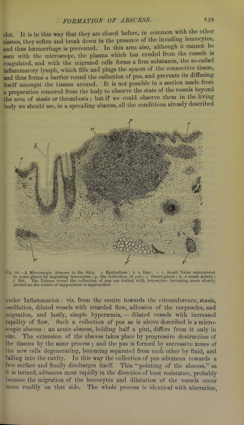 clot. It is in this way that they are closed before, in common with the other cissnes, they soften and break down in the presence of the invading leucocytes, and thus hsemorrhage is prevented. In this area also, although it cannot be seen with the microscope, the plasma which has exuded from the vessels is coagulated, and with the migrated cells forms a firm substance, tue so-called inflammatory lymph, which fills and plugs the spaces of the connective tissue, and thus forms a barrier round the collection of pus, and prevents its diffusing itself amongst the tissues around. It is not possible in a section made from a preparation removed from the body to observe the state of the vessels beyond the area of stasis or thrombosis ; but if we could observe them in the living body we should see, in a spreading abscess, all the conditions already described I'i^'. ;ss.—A Microscoph; Abscess in tlu; Skin. c. Epitlielinm ; h. a Hair; r. r. Siiiall Veins suiToundod in some places by niigratins leucocytes ; p. tlic collection of i)ns ; Sweat-gland ; 7). a small Artery ; /. Fat. The Tissues round the (lollectiou of pus are dotted with leucocytes becoming more closely imckeil as the centre of sup]iiuution is approached. under Inflammation : viz. from the centre towards the circumference, stasis, oscillation, dilated vessels with retarded flow, adhesion of the corpuscles, and migration, and lastly, simple hyperasmia, — dilated vessels with increased rapidity of flow. Such a collection of pus as is above described is a micro- scopic abscess ; an acute abscess, holding half a pint, differs from it only in size. The extension of the abscess takes place by progressive destruction of tlie tissues by the same process ; and the pus is formed by successive zones of the new cells degenerating, becoming separated from each other by fluid, and falling into the cavity. In this way the collection of pus advances towards a free surface and finally discharges itself. This pointing of the abscess, as it is termed, advances most rapidly in the direction of least resistance, probably because the migration of the leucocytes and dilatation of the vessels occur more readily on that side. The Avhole process is identical with ulceration,