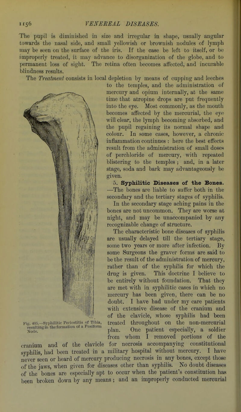 The pupil is dimiuisliecl iu size and irregular in shape, usually angular towards the nasal side, and small yellowish or brownish nodules of lymph may be seen on the surface of the iris. If the case be left to itself, or be improperly treated, it may advance to disorganization of the globe, and to permanent loss of sight. The retina often becomes affected, and incurable blindness results. The Treatment consists in local depletion by means of cupping and leeches to the temples, and the administration of mercury and opium internally, at the same time that atropine drops are put frequently into the eye. Most commonly, as the mouth becomes afi'ected by the mercurial, the ey(i will clear, the lymph becoming absorbed, and the pupil regaining its normal shape and colour. In some cases, however, a chronic inflammation continues : here the best effects result from the administration of small doses of perchloride of mercury, with repeated blistering to the temples ; and, in a later stage, soda and bark may advantageously be given. 5. Syphilitic Diseases of the Bones. —The bones are liable to suffer both in the secondary and the tertiary stages of syphilis. In the secondary stage aching pains in the bones are not uncommon. They are worse at night, and may be unaccompanied by any recognizable change of structure. The characteristic bone diseases of syphilis are usually delayed till the tertiary stage, some two years or more after infection. By some Surgeons the graver forms are said to be the result of the administration of mercury, rather than of the syphilis for which the drug is given. This doctrine I believe to be entirely without foundation. That they are met with in syphilitic cases in which no mercury has been given, there can be no doubt. I have had under my care patients with extensive disease of the cranium and of the clavicle, whose syphihs had been treated throughout on the non-mercurial plan. One patient especially, a soldier from whom I removed portions of the cranium and of the clavicle for necrosis accompanying constitutional syphilis, had been treated in a military hospital without mercury. I have never seen or heard of mercury producing necrosis in any bones, except those of the jaws, when given for diseases other than syphilis. No doubt diseases of the bones are especially apt to occur Avhen the patient's constitution has been broken down by any means ; and an improperly conducted mercurial FiK. 405.—Syphilitic Periostitis of Tibia, resulting ill thefonnation of a Fusiform Node.