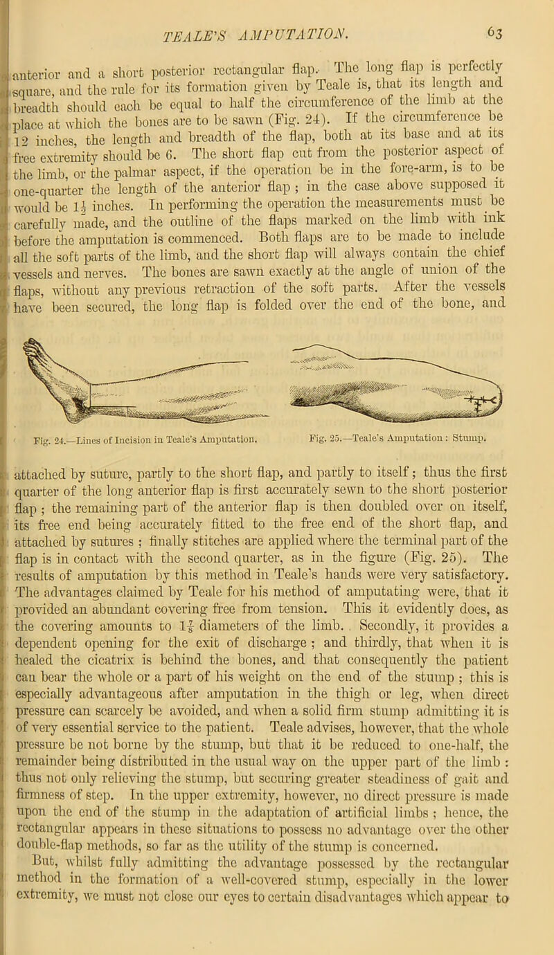 anterior and a short posterior rectangular flap, I he long flap is perfectly square, and the rule for its formation given by Tcale is, that its length and breadth should each be equal to half the circumference of the limb at the place at which the bones are to be sawn (Fig. 24). If the circumference be 12 inches the length and breadth of the flap, both at its base and at its free extremity should be 6. The short flap cut from the posterior aspect of the limb, or the palmar aspect, if the operation be in the fore-arm, is to be one-quarter the length of the anterior flap ; in the case above supposed it would be 14 inches. In performing the operation the measurements must be carefully made, and the outline of the flaps marked on the limb with ink (before the amputation is commenced. Both flaps are to be made to include all the soft parts of the limb, and the short flap will always contain the chief vessels and nerves. The bones are sawn exactly at the angle of union of the flaps, without any previous retraction of the soft parts. After the vessels have been secured, the long flap is folded over the end of the bone, and Fig. 24.—Lines of Incision in Teale's Amputation. Fig. 23.—Teale’s Amputation : Stump. I attached by suture, partly to the short flap, and partly to itself; thus the first ; quarter of the long anterior flap is first accurately sewn to the short posterior flap ; the remaining part of the anterior flap is then doubled over on itself, , its free end being accurately fitted to the free end of the short flap, and 1 attached by sutures ; finally stitches are applied where the terminal part of the flap is in contact with the second quarter, as in the figure (Fig. 25). The ! results of amputation by this method in Teale’s hands were very satisfactory. The advantages claimed by Teale for his method of amputating were, that it . provided an abundant covering free from tension. This it evidently does, as !the covering amounts to If diameters of the limb. Secondly, it provides a dependent opening for the exit of discharge ; and thirdly, that when it is healed the cicatrix is behind the bones, and that consequently the patient i can bear the whole or a part of his weight on the end of the stump ; this is especially advantageous after amputation in the thigh or leg, when direct pressure can scarcely be avoided, and when a solid firm stump admitting it is of very essential service to the patient. Teale advises, however, that the whole ! pressure be not borne by the stump, but that it be reduced to one-half, the remainder being distributed in the usual way on the upper part of the limb : I thus not only relieving the stump, but securing greater steadiness of gait and 1 firmness of step. In the upper extremity, however, no direct pressure is made upon the end of the stump in the adaptation of artificial limbs ; hence, the rectangular appears in these situations to possess no advantage over the other double-flap methods, so far as the utility of the stump is concerned. But, whilst fully admitting the advantage possessed by the rectangular method in the formation of a well-covered stump, especially in the lower extremity, we must not close our eyes to certain disadvantages which appear to