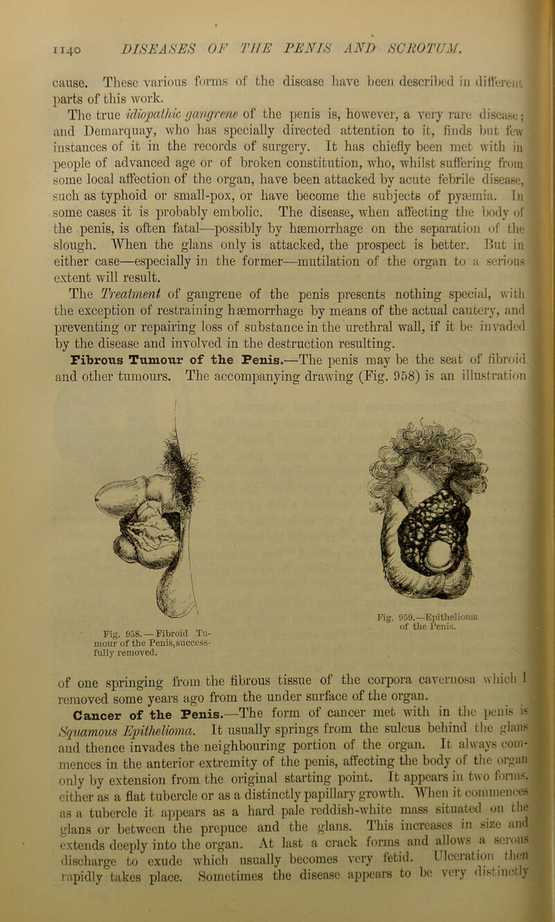 cause. These various forms of the disease liave ))cen descriljod in different; parts of this work. Tlie true idiojpcithic (jangrenc of tlie penis is, howeA'cr, a very i-ai'c disease; and Deniarquay, who has specially directed attention to it, finds hut few instances of it in the records of surgery. It has chiefly been met with in people of advanced age or of broken constitution, who, whilst suffering fi’om some local affection of the organ, have been attacked by acute febrile disease, such as typhoid or small-pox, or have become the subjects of pya3inia. In some cases it is probably embolic. The disease, when affecting tlie body of the penis, is often fatal—possibly by hmmoiThage on the separation of the slough. When the gians only is attacked, the prospect is better. But in either case—especially in the former—mutilation of the organ to a serious extent will result. The Treatment of gangrene of the penis presents nothing special, with the exception of restraining haemorrhage by means of the actual cautery, and preventing or repairing loss of substance in the urethral wall, if it be in vaded by the disease and involved in the destruction resulting. Fibrous Tumour of the Penis.—The penis may be the seat of fibroid and other tumours. The accompanying drawing (Tig. 958) is an illustration I I UOO» A'lUlUlll X 14- mour of the Penis, success- fully removed. Qjp one springing from the fibrous tissue of the corpora caverno.'^a which I removed some years ago from the under surface of the organ. Cancer of the Penis.—The form of cancer met with in the penis is Squamous Epithelioma. It usually springs from the sulcus behind the glaiis and thence invades the neighbouring portion of the organ. It always com- mences in the anterior extremity of the penis, affecting the body of the organ only by extension from the original starting point. It appears in two forms, cither as a flat tubercle or as a distinctly papillary growth. Wien it commences as a tubercle it appears as a hard pale reddish-white mass sitmited on the gians or between the prepuce and the gians. lliis increases in size and e.xtends deeply into the organ. At last a crack forms and allows a serous discharge to exude which usually becomes very fetid. Ulcciation then rapidly takes place. Sometimes the disease appears to be very distinofi}