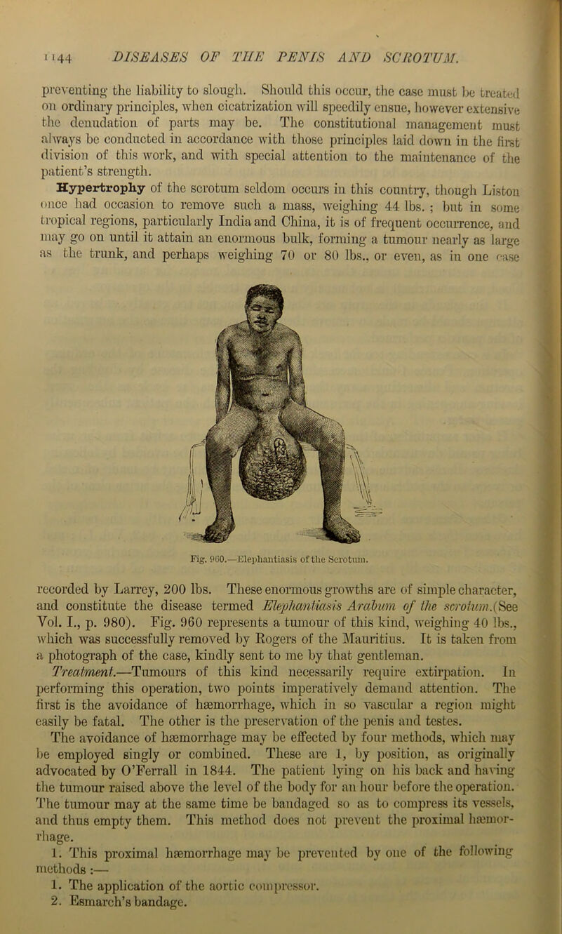 preventing- the liability to slough. Should this occur, the case must be treated on ordinary principles, when cicatrization Avill speedily ensue, however extensive the denudation of parts may be. The constitutional management must always be conducted in accordance with those principles laid down in the fii-st division of this work, and with special attention to the maintenance of the patient’s strength. Hypertrophy of the scrotum seldom ocem’s in this country, though Liston once had occasion to remove such a mass, weighing 44 lbs. ; but in some tropical regions, prticularly India and China, it is of frequent occurrence, and may go on until it attain an enormous bulk, forming a tumour nearly as large as the trunk, and perhaps weighing 70 or 80 lbs., or even, as in one f-ase recorded by Larrey, 200 lbs. These enormous growths are of simple character, and constitute the disease termed Elephantiasis Ardbum of the scrotum.(^eQ Vol. I., p. 980). Fig. 960 rejDresents a tumour of this kind, weighing 40 lbs., which was successfully removed by Rogers of the ]\Iamitius. It is taken from a photogi-aph of the case, kindly sent to me by that gentleman. Treatment.—Tumours of this kind necessarily require extirpation. In performing this operation, two points imperatively demand attention. The first is the avoidance of haemorrhage, which in so vascular a region might easily be fatal. The other is the preservation of the penis and testes. The avoidance of haemorrhage may be effected by four methods, which may be employed singly or combined. These are 1, by position, as originally advocated by O’Ferrall in 1844. The patient lying on his back and haA'ing the tumour raised above the level of the body for an hour before the operation. The tumour may at the same time be bandaged so as to compress its vessels, and thus empty them. This method does not prevent the proximal ha3mor- rhage. 1. This proximal haemorrhage may be prevented by one of the following methods :— 1. The application of the aortic compressor. 2. Esmarch’s bandage. Fig. P60.—Elephantiasis of the Scrotinn,