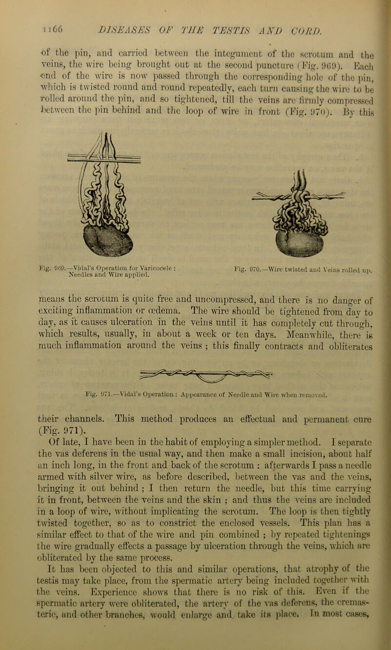 of the pin, and carried between the iiitef^iiment of the scrotum and the veins, the wire being brought out at the second jmnetnre (J<’ig. :)(b)). Each ■end of the wire is now passed through the corresponding hole of the ])iii, wliich is twisted round and round repeatedly, each turn causing the wire to be rolled around the pin, and so tightened, till the veins are firmly compressed between the pin behind and the loop of wire in front (Fig. !)7o;. By this Fig. 909.—Vidal’s Operation for Varicocele : Fig. 970.—Wii-e twisted and Veins rolled up Needles and Wire applied. means the scrotum is quite free and uncomiDressed, and there is no danger of exciting inflammation or oedema. The wdre should be tightened fi’om day to day, as it causes ulceration in the veins until it has completely cut through, which results, usually, in about a week or ten days. Meanwhile, there is much inflammation around the veins ; this finally contracts and obliterates Fig. 971.—Vidal’s Operation: Appearance of Needle and Wire when removed. their channels. This method produces an effectual and permanent cure (Fig-. 971). Of late, I have been in the habit of employing a simpler method. I separate the vas deferens in the usual way, and then make a small incision, about half an inch long, in the front and back of the scrotum : afterwards I pass a needle ai-med with silver wire, as before described, between the vas and the veins, bringing it out behind ; I then return the needle, but this time carrying it in front, between the veins and the skin ; and thus the veins arc included in a loop of wire, without implicating the scrotum. The loop is then tightly twisted together, so as to constrict the enclosed vessels. This plan has a similar effect to that of the wire and pin combined ; by repeated tightenings the wire gradually effects a passage by ulceration through the veins, which arc obliterated by the same process. It has been objected to this and similar operations, that atrophy of the testis may take place, from the spermatic artery being included together with the veins. Experience shows that there is no risk of this. Even if the spermatic arteiy were obliterated, the artery of the vas deferens, the cremas- teric, and other branches, would enlarge and take its place. In most cases,