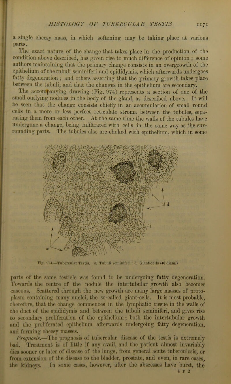 JIISTOLOGY OF TUBERCULAR TESTIS Ji single cheesy mass, iu which softening may be taking place at Yarious inirts. The exact nature of the change that takes place in the production of the condition above described, has given rise to much difference of opinion ; some authors maintaining that the primary change consists in an overgrowth of the epithelium of the tubuli seminiferi and epididymis, which afterwards undergoes tatty degeneration ; and others asserting that the primary growth takes place l)etweeii the tubuli, and that the changes in the epithelium are secondary. The accom|)aiiying drawing (Fig. 974) represents a section of one of the small outlying nodules iu the body of the gland, as described above. It will be seen that the change consists chiefly in an accumulation of small round cells in a more or less perfect reticulate stroma between the tubules, sepa- rating them from each other. At the same time the Avails of the tubules have undergone a change, being infiltrated Avith cells in the same Avay as the sur- rounding parts. The tubules also are choked with epithelium, AA’liich in some Kig. 074.—Tubercular Testis, a. Tubuli seminiferi: h. Giant-cells (40 diam.) parts of the same testicle Avas found to be undergoing fatty degeneration. 'ToAvards the centre of the nodule the intertubidar groAvth also becomes caseous. Scattered through the neAV groAvth are many large masses of proto- plasm containing many nuclei, the so-called giant-cells. It is most probable, therefore, that the change commences in the iMiiphatic tissue iu the Avails of the duct of the epididymis and betAvecii the tubuli seminiferi, and giA’es rise to secondaiy proliferation of the epithelium; both the intertubular groAvth and the proliferated epithelium afterAvards undergoing fatty degeneration, and forming cheesy masses. Frofjnosis.—The prognosis of tubenmlar disease of the testis is extremely bad. Treatment is of little if any avail, and the patient almost invariably dies sooner or later of disease of the lungs, IVom general acute tuberculosis, or from exten.sion of the disease to the bladder, prostate, and even, in rare cases, the kidneys. Iu some cases, hoAvever, after the abscesses have buret, the 4 F 2