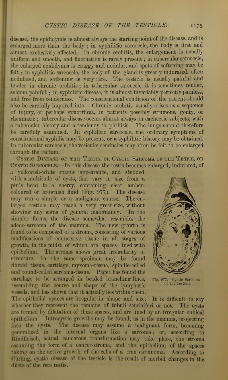 CYSTIC DISEASE OF THE TESTICLE. 1^5 disease, the epididymis is almost always tlie starting point of the disease, and is enlarged more than the body ; in syphilitic sarcocele, the body is first and almost exclusively aflected. In chronic orchitis, the enlargement is usually uniform and smooth, and fluctuation is rarely present; in tubercular sarcocele, the enlarged epididymis is craggy and nodular, and spots of softening may be felt ; in syphilitic sarcocele, the body of the gland is greatly indurated, often nodulated, and softening is very rare. The testicle is usually painful and tender in chronic orchitis; in tubercular sarcocele it is sometimes tender, seldom painful ; in syphilitic disease, it is almost invariably perfectly painless, and free from tenderness. The constitutional condition of the patient should also be carefully inquired into. Chronic orchitis usually arises as a sequence of injury, or perhaps gonorrhoea, in patients possibly strumous, gouty, or rheumatic ; tubercular disease occurs almost always in cachectic subjects, with a tubercular history and a tendency to phthisis. The lungs should therefore l3e carefully examined. In syphilitic sarcocele, the ordinary symptoms of constitutional syphilis may be present, or a syphilitic history may be obtained. Ill tubercular sarcocele, the vesiculm seminales may often be felt to be enlarged through the rectum. Cystic Disease of the Testis, or Cystic Sarcoma of the Testis, or Cystic Sarcocele.—In this disease the testis becomes enlarged, indurated, of a yellowish-white opaque appearance, and studded with a multitude of cysts, that vary in size from a pin’s head to a cheny, containing clear amber- coloured or brownish fluid (Fig. 977). The disease may run a simple or a malignant course. The en- larged testicle may reach a very great size, without showing any signs of general malignancy. In the simpler forms, the disease somewhat resembles the adeno-sarcoma of the mamma. The new growth is found to be composed of a stroma, consisting of various inodiflcations of connective tissue in all stages of growth, in the midst of which are spaces lined with epithelium. The stroma shows great irregularity of structure. In the same specimen may be found flbroid tissue, cartilage, myxoma-tissue, spindle-celled and round-celled sarcoma-tissue. Paget has found the (rartilage to be arranged in beaded branching lines, resembling the course and shape of the lymphatic vessels, and has shown that it actually lies within them. The epithelial spaces are irregular in shape and size. It is difl&cult to say whether they represent the remains of tubuli seminiferi or not. The cysts are formed by dilatation of these spaces, and arc lined by an irregular cubical epithelium. Intracystic growths may be found, as in the mamma, projecting into the cysts. The disease may a.ssumc a malignant form, becoming generalized in the internal oi'gans like a sarcoma; or, according to Kindfleisch, actual cancerous transformation may take place, the stroma iissuming the form of a caiicer-stroma, and the epithelium of the spaces taking on the active growth of the cells of a true carcinoma. According to Whirling, cystic disease of the testicle is the result of morbid changes in the ducts of the rete testis. Fig. 977.—Cystic Sarcoma