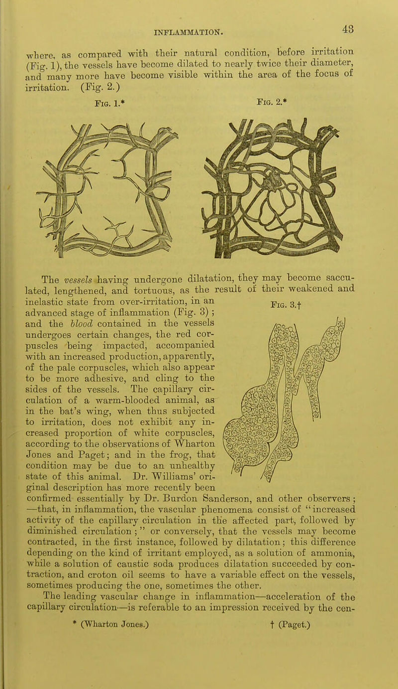 where, as compared with their natural condition, before irritation (Fig. 1), the vessels have become dilated to nearly twice their diameter, and many more have become visible within the area of the focus of irritation. (Fig. 2.) Fig. 1.* Fig. 2* Fig. 3.t The vessels having undergone dilatation, they may become saccu- lated, lengthened, and tortuous, as the result of their weakened and inelastic state from over-irritation, in an advanced stage of inflammation (Fig. 3) ; and the blood contained in the vessels undergoes certain changes, the red cor- puscles being impacted, accompanied with an increased production, apparently, of the pale corpuscles, which also appear to be more adhesive, and cling to the sides of the vessels. The capillary cir- culation of a warm-blooded animal, as in the bat's wing, when thus subjected to irritation, does not exhibit any in- creased proportion of white corpuscles, according to the observations of Wharton Jones and Paget; and in the frog, that condition may be due to an unhealthy state of this animal. Dr. Williams' ori- ginal description has more recently been confirmed essentially by Dr. Burdon Sanderson, and other observers ; —that, in inflammation, the vascular phenomena consist of increased activity of the capillary circulation in the affected part, followed by diminished circulation ;  or conversely, that the vessels may become contracted, in the first instance, followed by dilatation; this difference depending on the kind of irritant employed, as a solution of ammonia, while a solution of caustic soda produces dilatation succeeded by con- traction, and croton oil seems to have a variable effect on the vessels, sometimes producing the one, sometimes the other. The leading vascular change in inflammation—acceleration of the capillary circulation-—is referable to an impression received by the cen- (Wharton Jones.) t (Paget.)