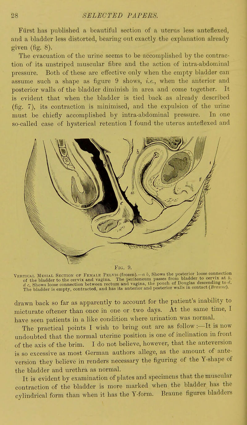 Fiivst has published a beautiful section of a uterus less anteflexed, and a bladder less distorted, bearing out exactly the explanation already given (fig. 8). The evacuation of the urine seems to be accomplished by the contrac- tion of its unstriped muscular fibre and the action of intra-abdomitial pressure. Both of these are effective only when the empty bladder can assume such a shape as figure 9 shows, i.e., when the anterior and posterior walls of the bladder diminish in area and come together. It is evident that when the bladder is tied back as already described (fig. 7), its contraction is minimised, and the expulsion of the urine must be chiefly accomplished by intra-abdominal pressure. In one so-called case of hysterical retention I found the uterus anteflexed and Fiu. 9. Vertical JIesial Section of Female Pelvis (frozen).-a b, Shows the posterior loose connection of the bladder to the cervix and vagina. The peritoneum passes from bladder to cervix at b. d c, Shows loose connection between rectum and vagina, the pouch of Douglas descending to rt. The bladder is empty, contracted, and has its anterior and posterior walls in contact {Bravne). drawn back so far as apparently to account for the patient's inability to micturate oftener than once in one or two days. At the same time, I have seen patients in a like condition where urination was normal. The practical points I wish to bring out are as follow :—It is now undoubted that the normal uterine position is one of inclination in front of the axis of the brim. I do not believe, however, that the anteversion is so excessive as most German authors allege, as the amount of ante- version they believe in renders necessary the figuring of the Y-shape of the bladder and urethra as normal. It is evident by examination of plates and specimens that the muscular contraction of the bladder is more marked when the bladder has the cylindrical form than when it has the Y-forra. Braune figures bladders