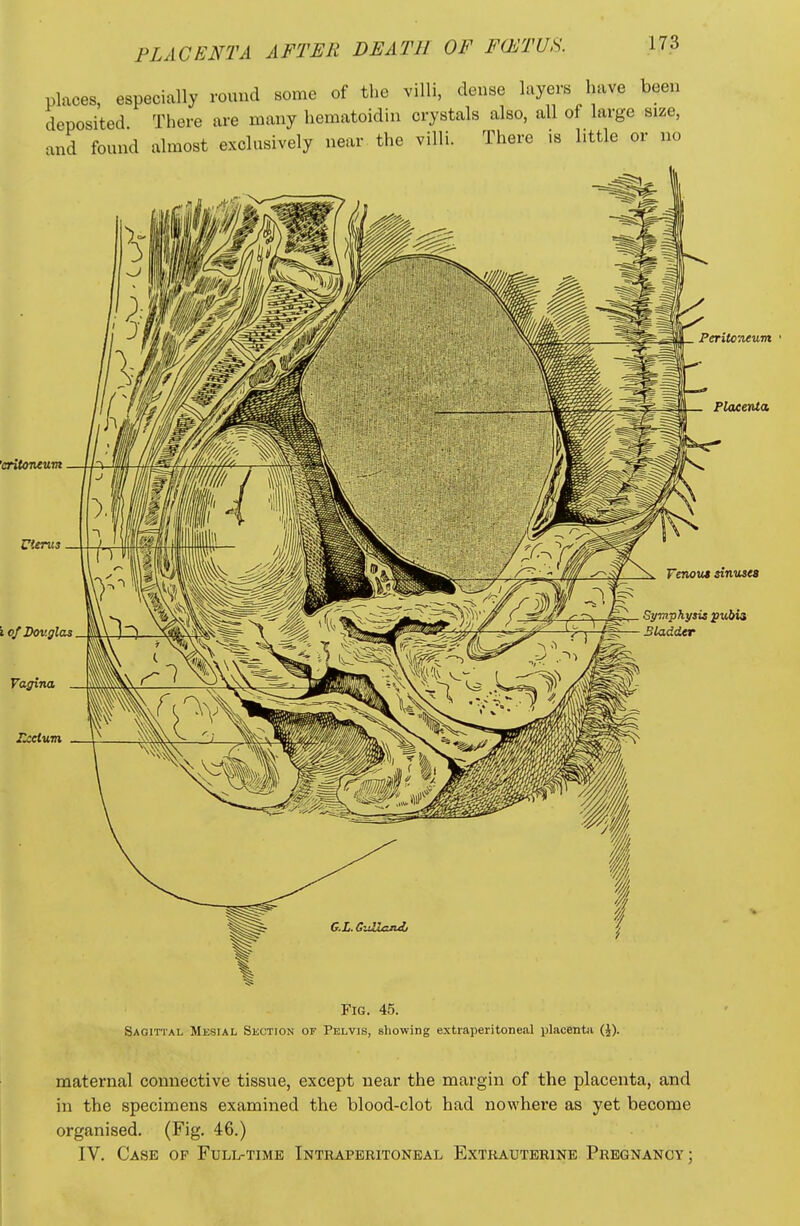 places, especially round some of the villi, dense layers have been deposited There are many hematoidin crystals also, all of large size, and found almost exclusively near the villi. There is little or no 'eritoneum Peritoneum Placenta Venous sinuses Symphysis pubin Bladder Fig. 45. Sagittal Mksial Section of Pelvis, showing extraperitone.al placenta (J). maternal connective tissue, except near the margin of the placenta, and in the specimens examined the blood-clot had nowhere as yet become organised. (Fig. 46.) IV. Case op Full-time Intraperitoneal Extrauterine Pregnancy;