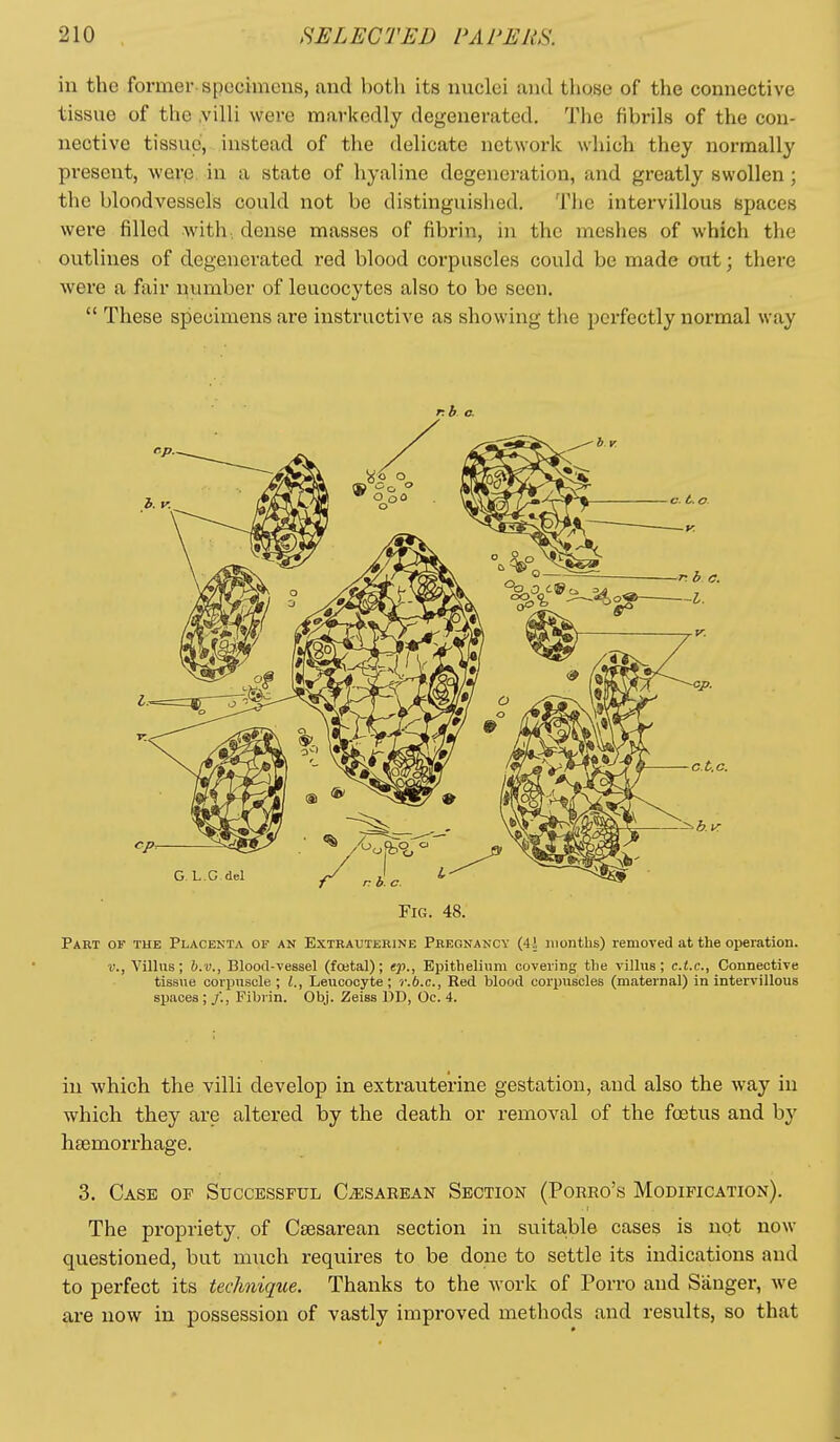 in the former specimens, and both its nuclei and those of the connective tissue of the .villi were markedly degenerated. The fibrils of the con- nective tissue, instead of the delicate network which they normally present, were in a state of hyaline degeneration, and greatly swollen; the bloodvessels could not be distinguislied. The intervillous spaces were filled with, dense masses of fibrin, in the meshes of which the outlines of degenerated red blood corpuscles could be made out; there were a fair number of leucocytes also to be seen.  These specimens are instructive as showing tlie perfectly normal way r.b c. Fig. 48. Part of the Placenta of an Extbauteeine Pregnancy (41 months) removed at the operation. v., Villus; h.v., Blood-Tessel (fcetal); ep.. Epithelium covering the villus; c.t.c. Connective tissue corpuscle ; I., Leucocyte; r.b.c, Red blood corpuscles (maternal) in intervillous spaces ; /., Fibrin. Obj. Zeiss 1)D, Oc. 4. in which the villi develop in extrauterine gestation, and also the way in which they are altered by the death or removal of the fostus and b}^ htemorrhage. 3. Case op Successful CiESAREAN Section (Porro's Modification). The propriety, of Csesarean section in su.itable cases is not now questioned, but much requires to be done to settle its indications and to perfect its technique. Thanks to the work of Porro and Sanger, we are now in possession of vastly improved methods and results, so that