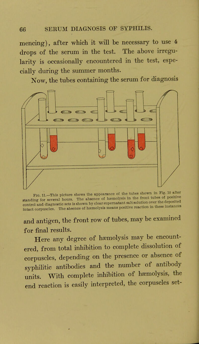 mencing), after which it will be necessary to use 4 drops of the serum in the test. The above irregu- larity is occasionally encountered in the test, espe- cially during the summer months. Now, the tubes containing the serum for diagnosis fx 1 : ■ -3 —H D > 4^3^ 41)111—% fllBEi: EJijt <i^^3!> <1!U 'lip <J ( 1 » <i 0 Fig 11 -This picture shows the appearance of the tuhes shown in Fig. 10 after standing for several hours. The absence of hemolysis in the front tu^f^^^ P°'^*;j^ control and diagnostic sets is shown by clear supernatant salt solution over the deposited intact corpuscles. The absence of hemolysis means positive reaction m these instances and antigen, the front row of tubes, may be examined for final results. Here any degree of hemolysis may be encount- ered, from total inhibition to complete dissolution of corpuscles, depending on the presence or absence of syphiHtic antibodies and the number of antibody units. With complete inhibition of hasmolysis, the end reaction is easily interpreted, the corpuscles set-