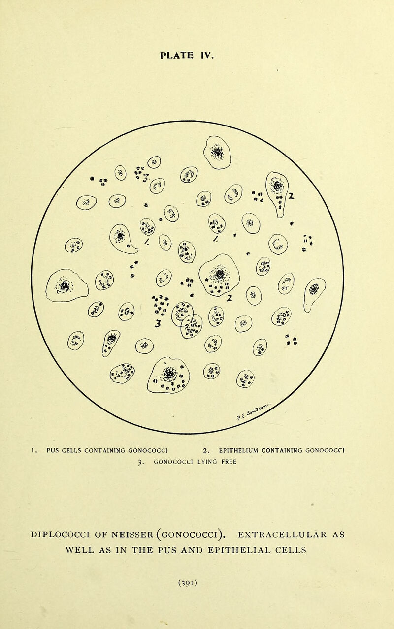 I. PUS CELLS CONTAINING GONOCOCCI 2. EPITHELIUM CONTAINING GONOCOCCI 3. GONOCOCCI LYING FREE DIPLOCOCCI OF NEISSER (gonococci). EXTRACELLULAR AS WELL AS IN THE PUS AND EPITHELIAL CELLS