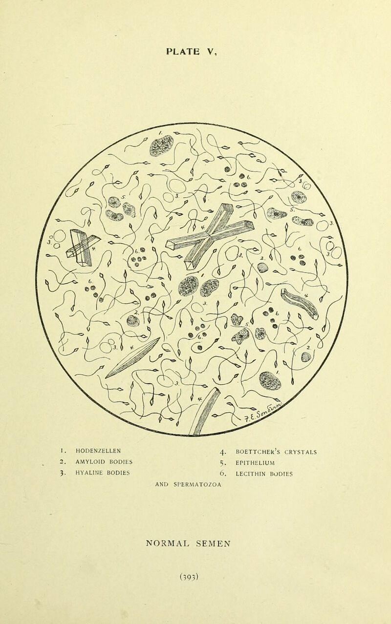 1. HODENZELLEN 4. BOETTCHEk’s CRYSTALS 2. AMYLOID BODIES 5. EPITHELIUM 3. HYALINE BODIES 6. LECITHIN BODIES AND SPERMATOZOA NORMAL SEMEN