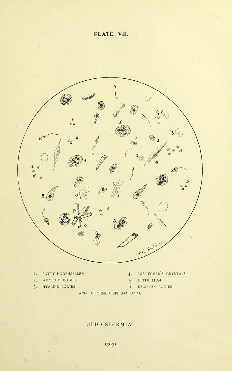 1. FATTY HODENZELLEN 4- BOETTCHER S CRYSTALS 2. AMYLOID BODIES 5- EPITHELIUM 3- HYALINE BODIES 6. LECITHIN BODIES AND DEFORMED SPERMATOZOA OLIGOSPERMIA