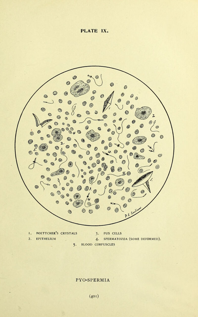 1. Boettcher’s crystals 2. EPITHELIUM 5. BLOOD 3. PUS CELLS 4. SPERMATOZOA (sOME DEFORMED). CORPUSCLES PYO-SPERMIA