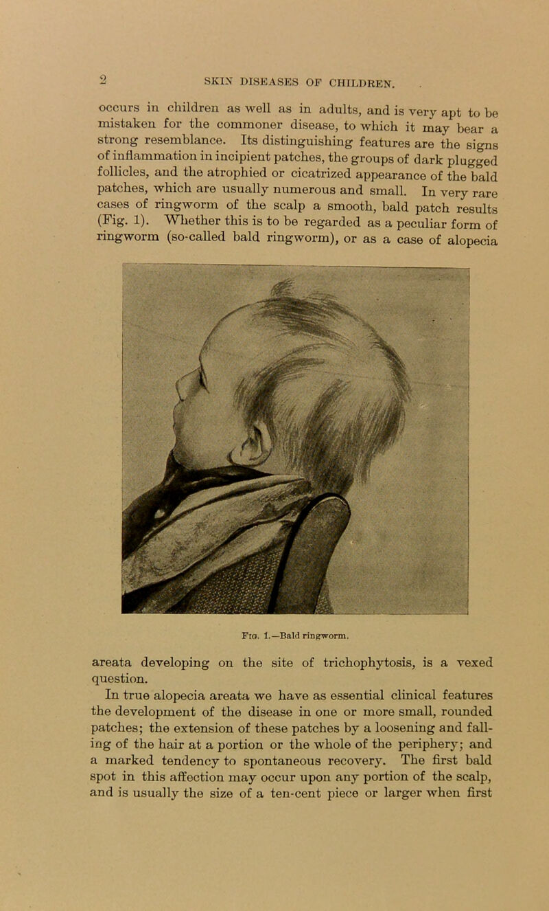 occurs in children as well as in adults, and is very apt to be mistaken for the commoner disease, to which it may bear a strong resemblance. Its distinguishing features are the signs of inflammation in incipient patches, the groups of dark plugged follicles, and the atrophied or cicatrized appearance of the bald patches, which are usually numerous and small. In very rare cases of ringworm of the scalp a smooth, bald patch results (Fig. 1). Whether this is to be regarded as a peculiar form of ringworm (so-called bald ringworm), or as a case of alopecia Fto. 1.—Bald ringworm. areata developing on the site of trichophytosis, is a vexed question. In true alopecia areata we have as essential clinical features the development of the disease in one or more small, rounded patches; the extension of these patches by a loosening and fall- ing of the hair at a portion or the whole of the periphery; and a marked tendency to spontaneous recovery. The first bald spot in this affection may occur upon any portion of the scalp, and is usually the size of a ten-cent piece or larger when first