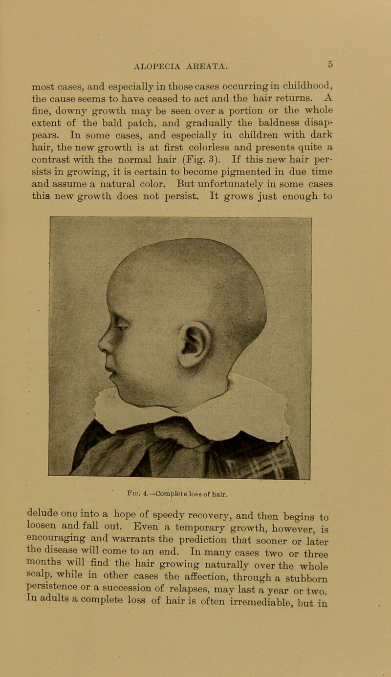 most cases, and especially in those cases occurring in childhood, the cause seems to have ceased to act and the hair returns. A fine, downy growth may he seen over a portion or the whole extent of the bald patch, and gradually the baldness disap- pears. In some cases, and especially in children with dark hair, the new growth is at first colorless and presents quite a contrast with the normal hair (Fig. 3). If this new hair per- sists in growing, it is certain to become pigmented in due time and assume a natural color. But unfortunately in some cases this new growth does not persist. It grows just enough to F[g. 4.—Complete loss of hair. delude one into a hope of speedy recovery, and then begins to loosen and fall out. Even a temporary growth, however, is encouraging and warrants the prediction that sooner or later the disease will come to an end. In many cases two or three months will find the hair growing naturally over the whole scalp, while in other cases the affection, through a stubborn persistence or a succession of relapses, may last a year or two. In adults a complete loss of hair is often irremediable, hut in