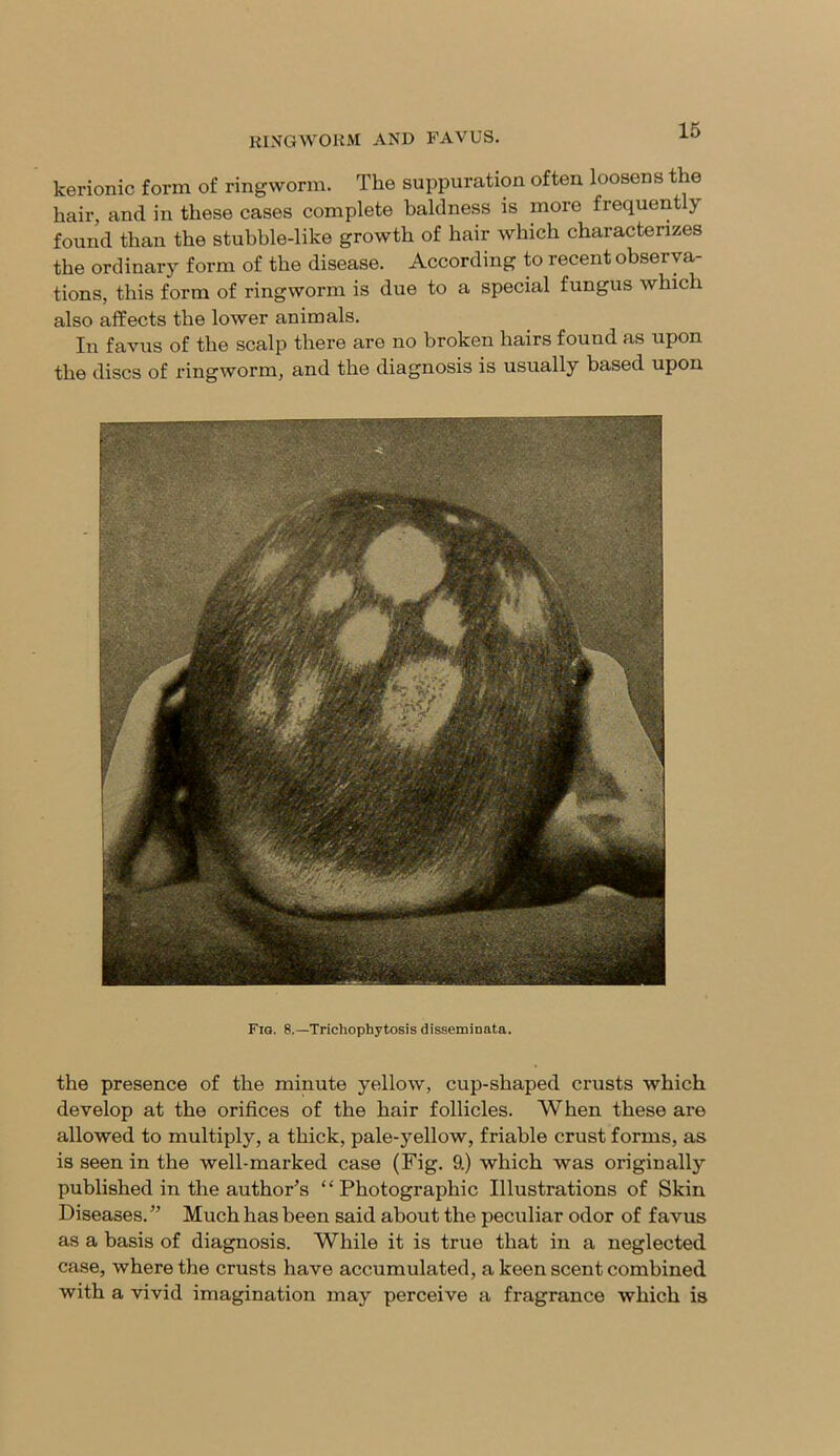 kerionic form of ringworm. The suppuration often loosens the hair, and in these cases complete baldness is more frequently found than the stubble-like growth of hair which characterizes the ordinary form of the disease. According to recent observa- tions, this form of ringworm is due to a special fungus which also affects the lower animals. In favus of the scalp there are no broken hairs found as upon the discs of ringworm, and the diagnosis is usually based upon Fig. 8.—Trichophytosis disseminata. the presence of the minute yellow, cup-shaped crusts which develop at the orifices of the hair follicles. When these are allowed to multiply, a thick, pale-yellow, friable crust forms, as is seen in the well-marked case (Fig. 9.) which was originally published in the author’s ‘‘Photographic Illustrations of Skin Diseases.” Much has been said about the peculiar odor of favus as a basis of diagnosis. While it is true that in a neglected case, where the crusts have accumulated, a keen scent combined with a vivid imagination may perceive a fragrance which is