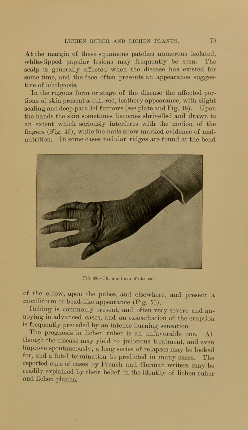 At the margin of these squamous patches numerous isolated, white-tipped papular lesions may frequently be seen. The scalp is generally affected when the disease has existed for some time, and the face often presents an apj)earance sugges- tive of ichthyosis. In the rugous form or stage of the disease the affected por- tions of skin present a dull-red, leathery appearance, with slight scaling and deep parallel furrows (see plate and Fig. 48). Upon the hands the skin sometimes becomes shrivelled and drawn to an extent which seriously interferes with the motion of the fingers (Fig. 49), while the nails show marked evidence of mal- nutrition. In some cases nodular ridges are found at the bend Fig. 49.—Chronic form of disease. of the elbow, upon the pubes, and elsewhere, and present a moniliform or bead-like appearance (Fig. 50). Itching is commonly present, and often very severe and an- noying in advanced cases, and an exacerbation of the eruption is frequently preceded by an intense burning sensation. The prognosis in lichen ruber is an unfavorable one. Al- though the disease may yield to judicious treatment, and even improve spontaneously, a long series of relapses may be looked for, and a fatal termination be predicted in many cases. The reported cure of cases by French and German writers may be readily explained by their belief in the identity of lichen ruber and lichen planus.