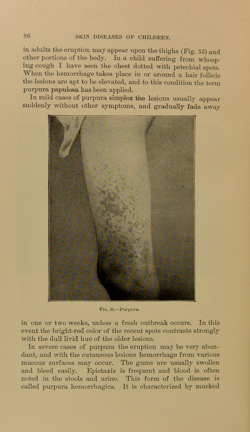 8G in adults the eruption may appear upon the thighs (Fig. 55) and other portions of the body. In a child suffering from whoop- ing cough I have seen the chest dotted with petechial spots. When the hemorrhage takes place in or around a hair follicle the lesions are apt to be elevated, and to this condition the term purpura papulosa has been applied. In mild cases of purpura simplex the lesions usually appear suddenly without other symptoms, and gradually fade away Fig, 55.—Purpura. in one or two weeks, unless a fresh outbreak occurs. In this event the bright-red color of the recent spots contrasts strongly with the dull livid hue of the older lesions. In severe cases of purpura the eruption may be very abun- dant, and with the cutaneous lesions hemorrhage from various mucous surfaces may occur. The gums are usually swollen and bleed easily. Epistaxis is frequent and blood is often noted in the stools and urine. This form of the disease is called purpura hemorrhagica. It is characterized by marked