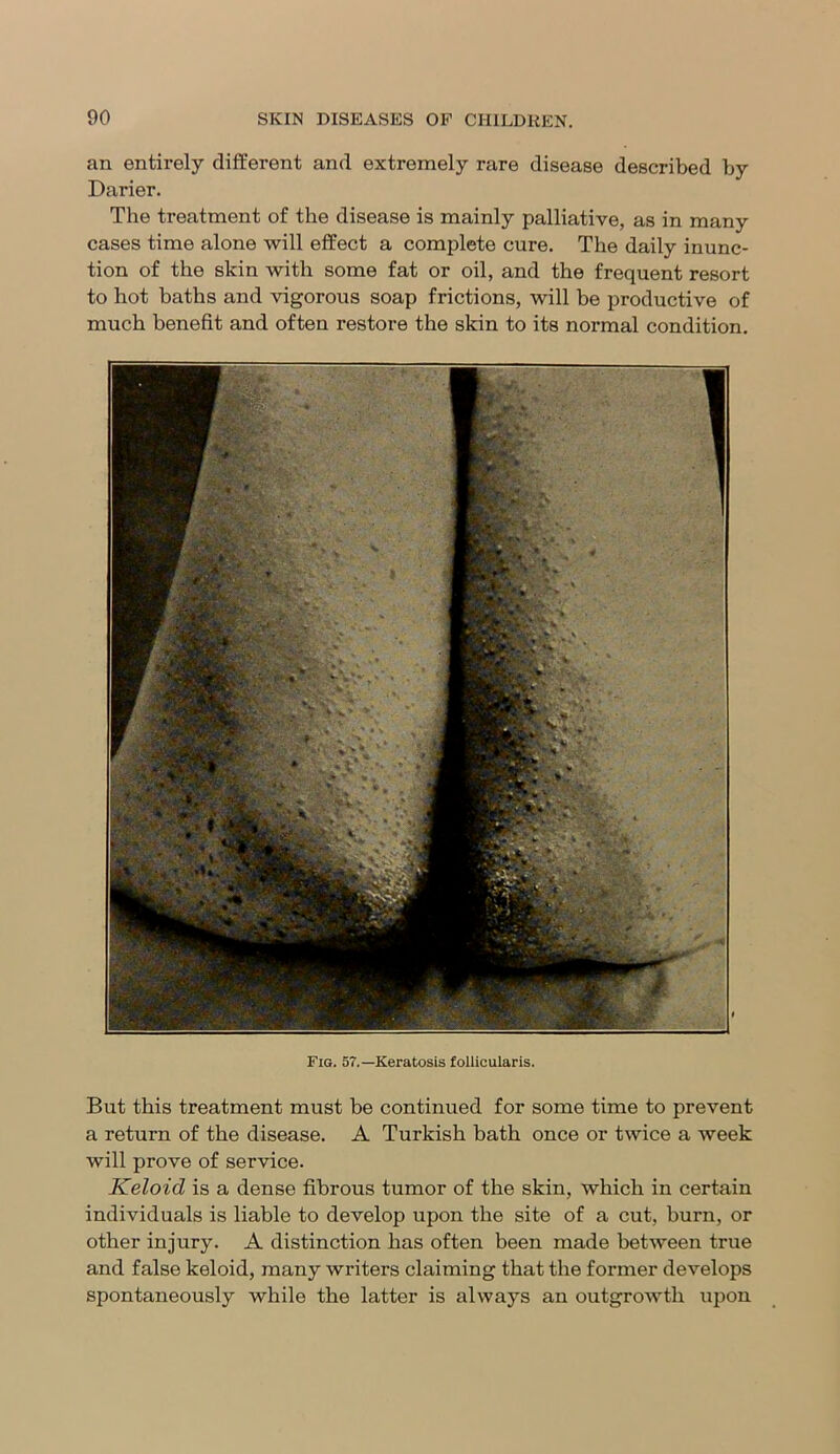 an entirely different and extremely rare disease described by Darier. The treatment of the disease is mainly palliative, as in many cases time alone will effect a complete cure. The daily inunc- tion of the skin with some fat or oil, and the frequent resort to hot baths and vigorous soap frictions, will be productive of much benefit and often restore the skin to its normal condition. Fig. 57.—Keratosis follicularis. But this treatment must be continued for some time to prevent a return of the disease. A Turkish bath once or twice a week will prove of service. Keloicl is a dense fibrous tumor of the skin, which in certain individuals is liable to develop upon the site of a cut, burn, or other injury. A distinction has often been made between true and false keloid, many writers claiming that the former develops spontaneously while the latter is always an outgrowth upon