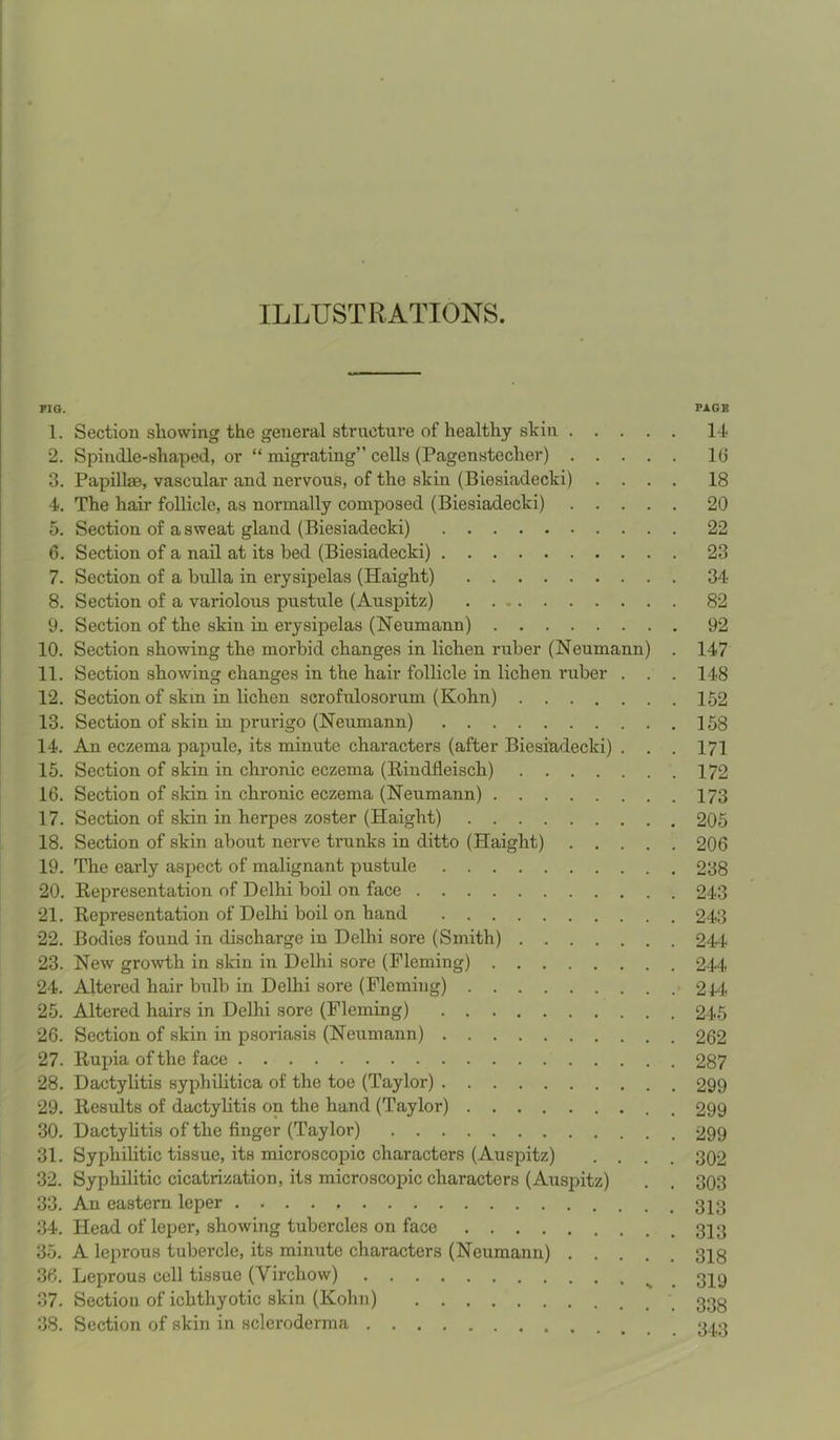 ILLUSTRATIONS. FIG. PAGE 1. Section showing the general structure of healthy shin 14 2. Spindle-shaped, or “ migrating” cells (Pagenstecher) 10 3. Papillm, vascular and nervous, of the skin (Biesiadecki) .... 18 4. The hair follicle, as normally composed (Biesiadecki) 20 5. Section of a sweat gland (Biesiadecki) 22 6. Section of a nail at its bed (Biesiadecki) 23 7. Section of a bulla in erysipelas (Haight) 34 8. Section of a variolous pustule (Auspitz) 82 9. Section of the skin in erysipelas (Neumann) 92 10. Section showing the morbid changes in lichen ruber (Neumann) . 147 11. Section showing changes in the hair follicle in lichen ruber . . . 148 12. Section of skm in lichen scrofulosorum (Kohn) 152 13. Section of skin in prurigo (Neumann) 158 14. An eczema papule, its minute characters (after Biesiadecki) . . . 171 15. Section of skin in chronic eczema (Rindfleisch) 172 16. Section of skin in chronic eczema (Neumann) 173 17. Section of skin in herpes zoster (Haight) 205 18. Section of skin about nerve trunks in ditto (Haight) 206 19. The early aspect of malignant pustule 238 20. Representation of Delhi boil on face 243 21. Representation of Delhi boil on hand 243 22. Bodies found in discharge in Delhi sore (Smith) 244 23. New growth in skin in Delhi sore (Fleming) 244 24. Altered hair bulb in Delhi sore (Fleming) < 244 25. Altered hairs in Delhi sore (Fleming) 245 26. Section of skin in psoriasis (Neumann) 262 27. Rupia of the face 287 28. Dactylitis syphilitica of the toe (Taylor) 299 29. Results of dactylitis on the hand (Taylor) 299 30. Dactylitis of the finger (Taylor) 299 31. Syphilitic tissue, its microscopic characters (Auspitz) .... 302 32. Syphilitic cicatrization, its microscopic characters (Auspitz) . . 303 33. An eastern leper . . . . 34. Head of leper, showing tubercles on face 313 35. A leprous tubercle, its minute characters (Neumann) 318 36. Leprous cell tissue (Virchow) 37. Section of ichthyotic skin (Kohn) \ 333 38. Section of skin in scleroderma