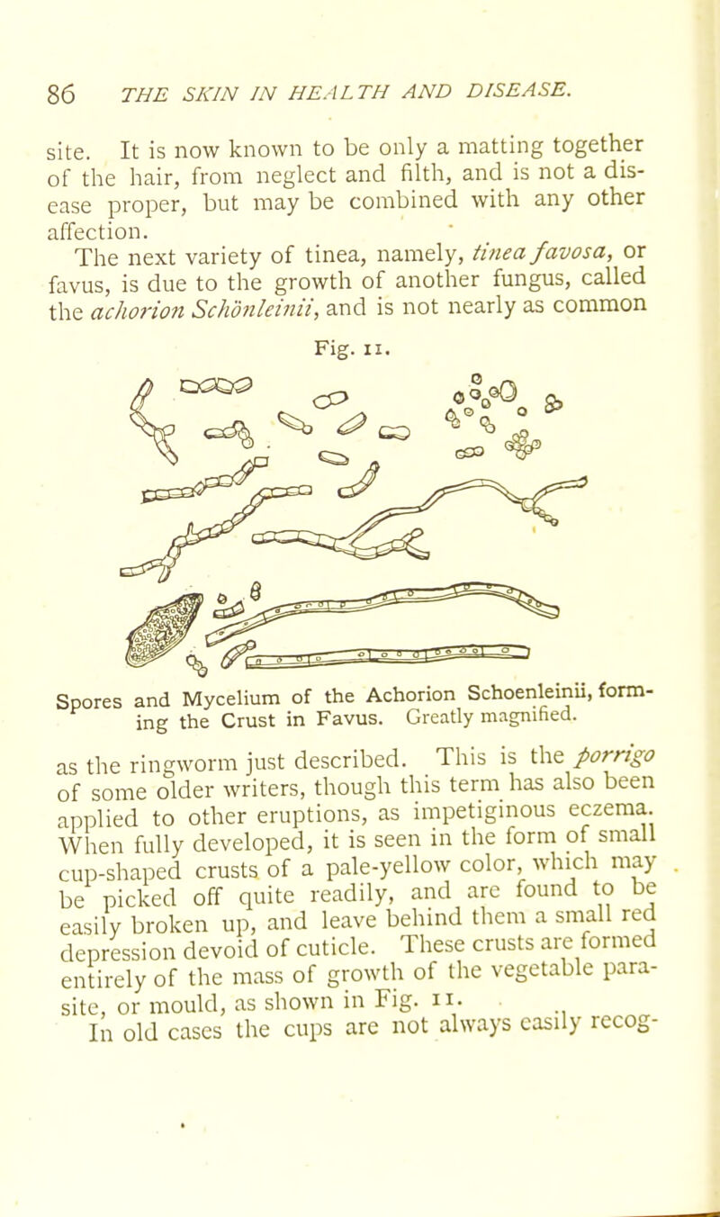 site. It is now known to be only a matting together of the hair, from neglect and filth, and is not a dis- ease proper, but may be combined with any other affection. The next variety of tinea, namely, tinea favosa, or favus, is due to the growth of another fungus, called the achorion Schdnleinii, and is not nearly as common Fig. n. Spores and Mycelium of the Achorion Schoenleinii, form- ing the Crust in Favus. Greatly magnified. as the ringworm just described. This is the porrigo of some older writers, though this term has also been applied to other eruptions, as impetiginous eczema When fully developed, it is seen in the form of small cup-shaped crusts of a pale-yellow color which may be picked off quite readily, and are found to be easily broken up, and leave behind them a small red depression devoid of cuticle. These crusts are formed entirely of the mass of growth of the vegetable para- site, or mould, as shown in Fig. n. In old cases the cups are not always easily recog-