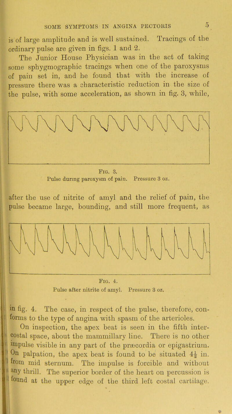 is of large amplitude and is well sustained. Tracings of the ordinary pulse are given in figs. 1 and 2. The Junior House Physician was in the act of taking some sphygmographic tracings when one of the paroxysms of pain set in, and he found that with the increase of pressure there was a characteristic reduction in the size of the pulse, with some acceleration, as shown in fig. 3, while. Fig. 3. Pulse during paroxysm of pain. Pressure 3 oz. after the use of nitrite of amyl and the relief of pain, the pulse became large, bounding, and still more frequent, as Fig. 4. Pulse after nitrite of amyl. Pressure 3 oz. I in fig. 4. The case, in respect of the pulse, therefore, con- t forms to the type of angina with spasm of the arterioles. On inspection, the apex beat is seen in the fifth inter- • costal space, about the mammillary line. There is no other > inipulse visible in any part of the praecordia or epigastrium. ’ On palpation, the apex beat is found to be situated 4^ in. I from mid sternum. The impulse is forcible and without ■I any thrill. The superior border of the heart on percussion is i found at the upper edge of the third left costal cartilage.