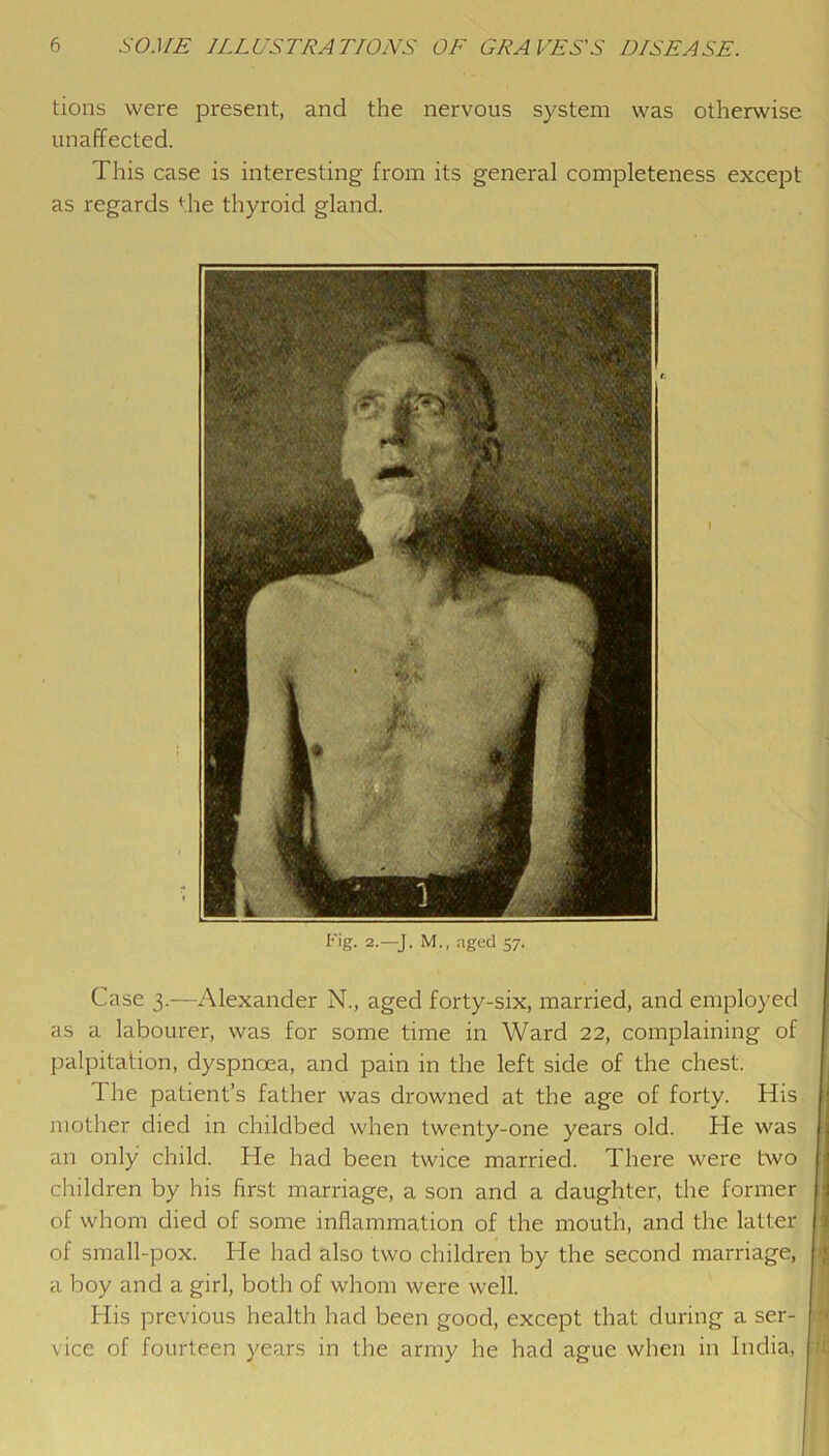 tions were present, and the nervous system was otherwise unaffected. This case is interesting from its general completeness except as regards <he thyroid gland. Fig. 2.—J. M., aged 57. Case 3.—Alexander N., aged forty-six, married, and employed as a labourer, was for some time in Ward 22, complaining of palpitation, dyspnoea, and pain in the left side of the chest. The patient’s father was drowned at the age of forty. His mother died in childbed when twenty-one years old. He was an only child. He had been twice married. There were two children by his lirst marriage, a son and a daughter, the former of whom died of some inflammation of the mouth, and the latter of small-pox. He had also two children by the second marriage, a boy and a girl, both of whom were well. His previous health had been good, except that during a ser- vice of fourteen years in the army he had ague when in India,