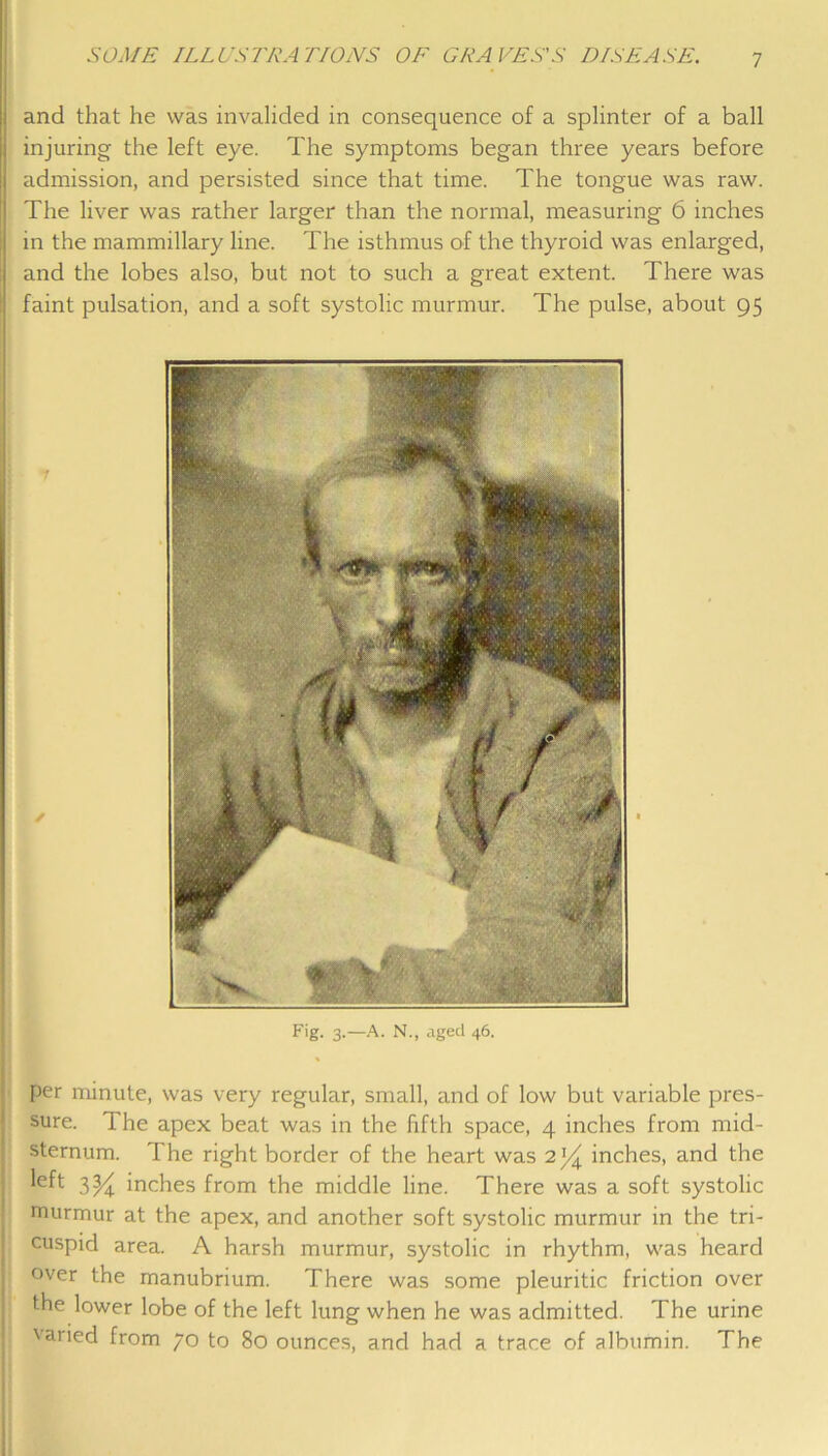 and that he was invalided in consequence of a splinter of a ball i injuring the left eye. The symptoms began three years before I admission, and persisted since that time. The tongue was raw. i The liver was rather larger than the normal, measuring 6 inches in the mammillary line. The isthmus of the thyroid was enlarged, I and the lobes also, but not to such a great extent. There was ; faint pulsation, and a soft systolic murmur. The pulse, about 95 Fig. 3.—.<\. N., aged 46. per minute, was very regular, small, and of low but variable pres- sure. The apex beat was in the fifth space, 4 inches from mid- sternum. The right border of the heart was 2 inches, and the 3% inches from the middle line. There was a soft systolic murmur at the apex, and another soft systolic murmur in the tri- cuspid area. A harsh murmur, systolic in rhythm, was heard over the manubrium. There was some pleuritic friction over the lower lobe of the left lung when he was admitted. The urine 'aried from 70 to 80 ounces, and had a trace of albumin. The