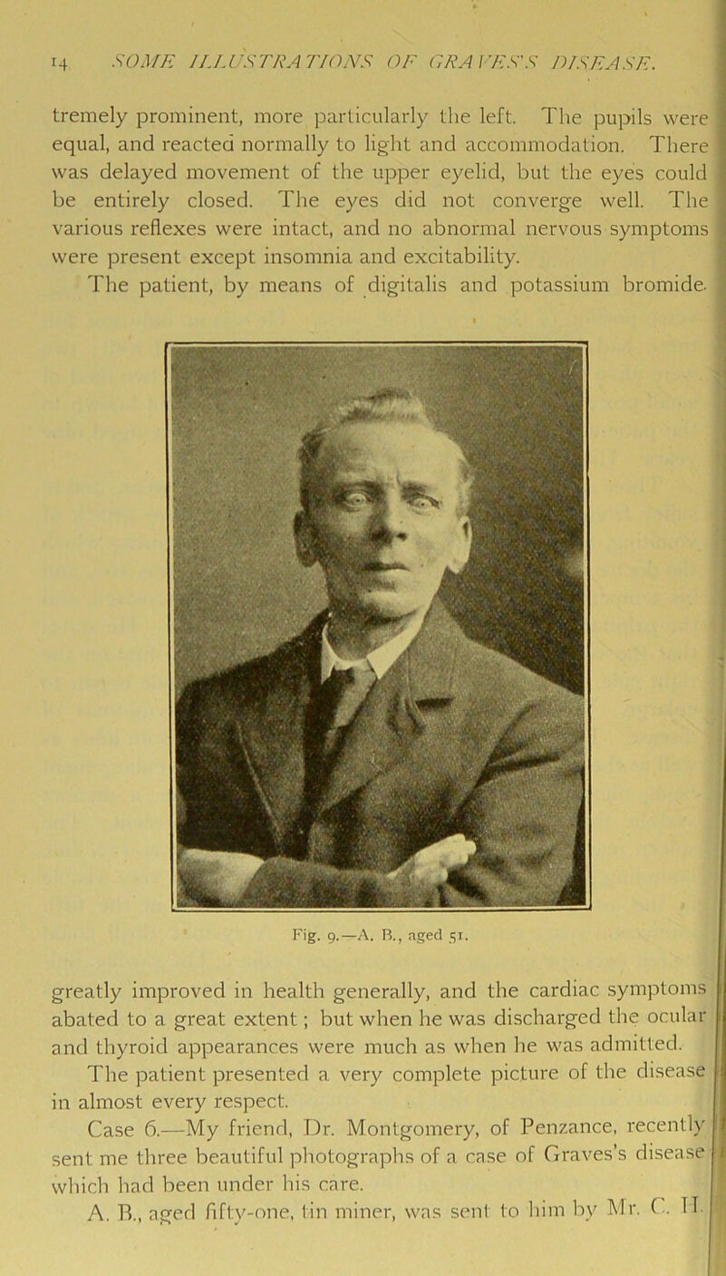 tremely prominent, more particularly the left. The pupils were equal, and reacted normally to light and accommodation. There was delayed movement of the upper eyelid, but the eyes could / be entirely closed. The eyes did not converge well. The f various reflexes were intact, and no abnormal nervous symptoms j were present except insomnia and excitability. f The patient, by means of digitalis and potassium bromide. I Fig. 9.—A. B., aged 51. greatly improved in health generally, and the cardiac symptoms abated to a great extent; but when he was discharged the ocular and thyroid appearances were much as when he was admitted. The patient presented a very complete picture of the disease ; in almost every respect. Case 6.—My friend, Dr. Montgomery, of Penzance, recent!)’ i sent me three beautiful photographs of a case of Graves’s disease . which had been under his care. A. B., aged fifty-one, tin miner, was sent to liim bv Mr. ( . IT.