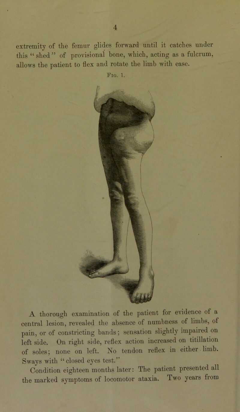 extremity of the femur glides forward until it catches under this “shed” of provisional bone, which, acting as a fulcrum, allows the patient to flex and rotate the limb with ease. Pig. 1. A thorough examination of the patient for evidence of a central lesion, revealed the absence of numbness of limbs, of pain, or of constricting bands; sensation slightly impaired on left side. On right side, reflex action increased on titillation of soles; none on left. No tendon reflex in either limb. Sways with “closed eyes test.” Condition eighteen months later: The patient presented all the marked symptoms of locomotor ataxia. Two years from