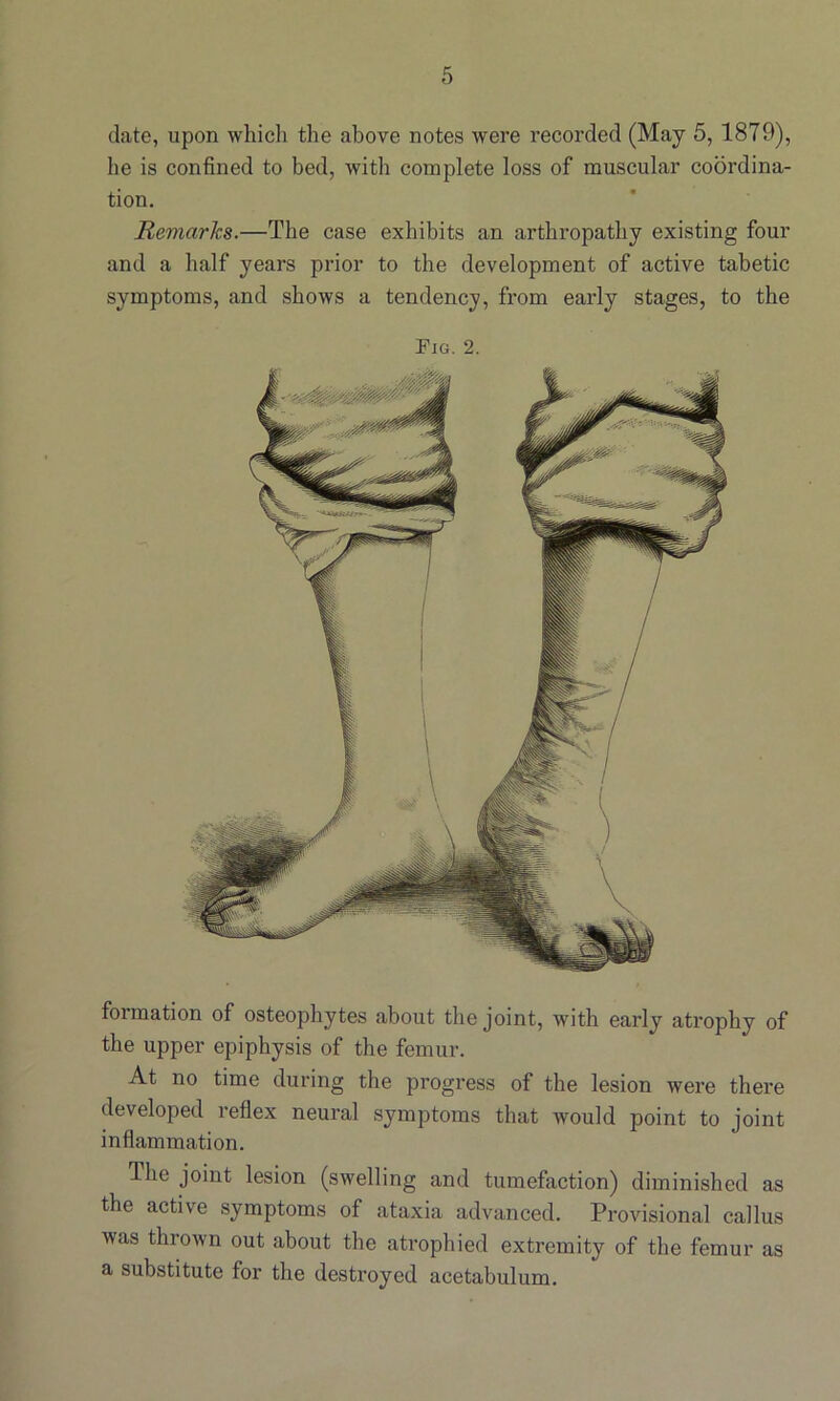 date, upon which the above notes were recorded (May 5, 1879), he is confined to bed, with complete loss of muscular coordina- tion. Remarks.—The case exhibits an arthropathy existing four and a half years prior to the development of active tabetic symptoms, and shows a tendency, from early stages, to the Fjg. 2. formation of osteophytes about the joint, with early atrophy of the upper epiphysis of the femur. At no time during the progress of the lesion were there developed reflex neural symptoms that would point to joint inflammation. The joint lesion (swelling and tumefaction) diminished as the active symptoms of ataxia advanced. Provisional callus was thrown out about the atrophied extremity of the femur as a substitute for the destroyed acetabulum.