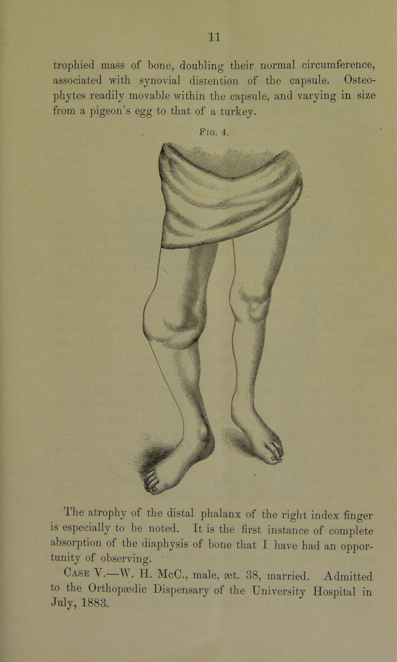 trophied mass of bone, doubling their normal circumference, associated with synovial distention of the capsule. Osteo- phytes readily movable within the capsule, and varying in size from a pigeon’s egg to that of a turkey. Fig. 4. lhe atrophy of the distal phalanx oi the right index finger is especially to be noted. It is the first instance of complete absorption of the diaphysis of bone that I have had an oppor- tunity of observing. Case V.—IV. H. McC., male, aet. 38, married. Admitted to the Orthopaedic Dispensary of the University Hospital in July, 1883.