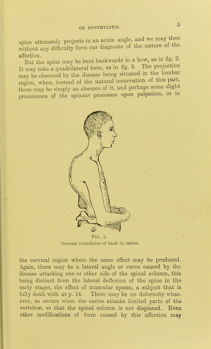 spine ultimately projects in an acute angle, and we may then without any difficulty form our diagnosis of the nature of the affection. -co But the spine may be bent backwards in a bow, as m hg. It may take a quadrilateral form, as in fig. 3. The projection may be obscured by the disease being situated m the lumbar region, when, instead of the natural incurvation of this part, there may be simply an absence of it, and perhaps some shght prominence of the spinous processes upon palpation, or in the cervical region where the same effect may be produced. Again, there may be a lateral angle or curve caused by the disease attacking one or other side of the spinal column, this being distinct from the lateral deflexion of the spine in the early stages, the effect of muscular spasm, a subject that is fully dealt with at p. 14. There may be no deformity what- ever, as occurs when the caries attacks limited parts of the vertebras, so that the spinal column is not displaced. Even other modifications of form caused by this affection may