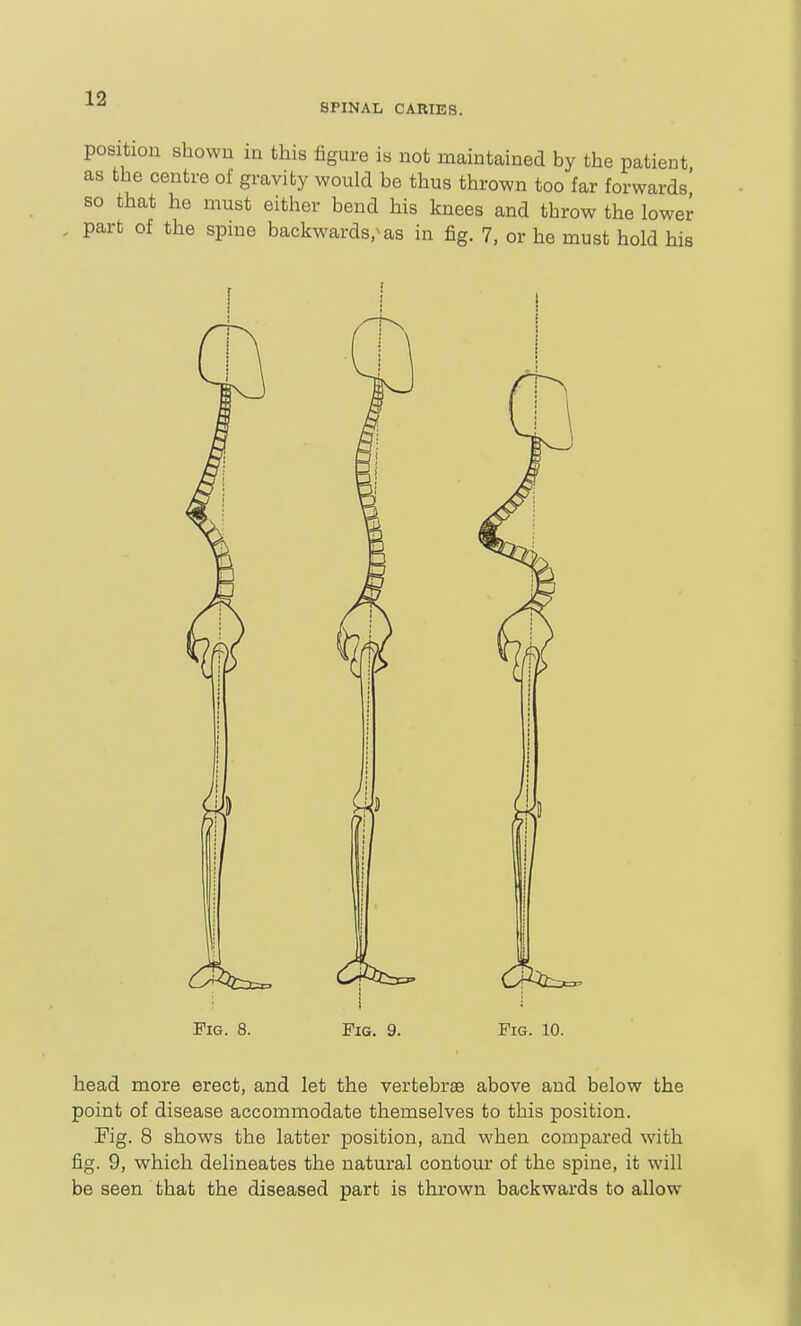 SPINAL CARIES. position shown m this figure is not maintained by the patient as the centre of gravity would be thus thrown too far forwards' so that he must either bend his knees and throw the lower , part of the spine backwards/as in fig. 7, or he must hold his Fig. 8. Fig. 9. Fig. 10. head more erect, and let the vertebrae above and below the point of disease accommodate themselves to this position. Fig. 8 shows the latter position, and when compared with fig. 9, which delineates the natural contour of the spine, it will be seen that the diseased part is thrown backwards to allow