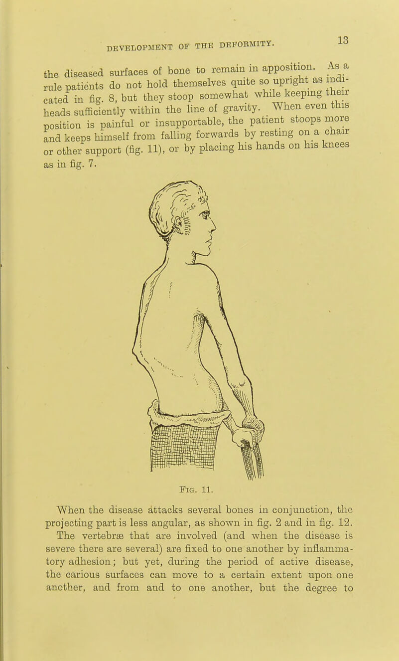 the diseased surfaces of bone to remain in apposition. As a rule patients do not hold themselves quite so upright as indi- cated in fig. 8, but they stoop somewhat while keeping their heads sufficiently within the line of gravity. When even this position is painful or insupportable, the patient stoops niore and keeps himself from falling forwards by resting on a chair or other support (fig. 11), or by placing his hands on his knees as in fig. 7. Fig. 11. When the disease attacks several bones in conjunction, the projecting part is less angular, as shown in fig. 2 and in fig. 12. The vertebrae that are involved (and when the disease is severe there are several) are fixed to one another by inflamma- tory adhesion; but yet, during the period of active disease, the carious surfaces can move to a certain extent upon one another, and from and to one another, but the degree to