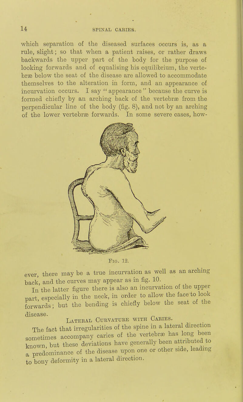 which separation of the diseased surfaces occurs is, as a rule, slight; so that when a patient raises, or rather draws backwards the upper part of the body for the purpose of looking forwards and of equalising his equilibrium, the verte- brae below the seat of the disease are allowed to accommodate themselves to the alteration in form, and an appearance of incurvation occurs. I say  appearance  because the curve is formed chiefly by an arching back of the vertebrae from the perpendicular line of the body (fig. 8), and not by an arching of the lower vertebrae forwards. In some severe cases, how- FiG. 12. ever, there may be a true incurvation as well as an arching back, and the curves may appear as in fig. 10. In the latter figure there is also an incurvation of the upper part especially in the neck, in order to allow the face to look forwards; but the bending is chiefly below the seat of the Latebal Curvatuee with Caeies. The fact that irregularities of the spine in a lateral direction sometimes accompany caries of the vertebra ^^\}T\^'!Z known but these deviations have generally been attributed to a predominance of the disease upon one or other side, leading to bony deformity in a lateral direction.